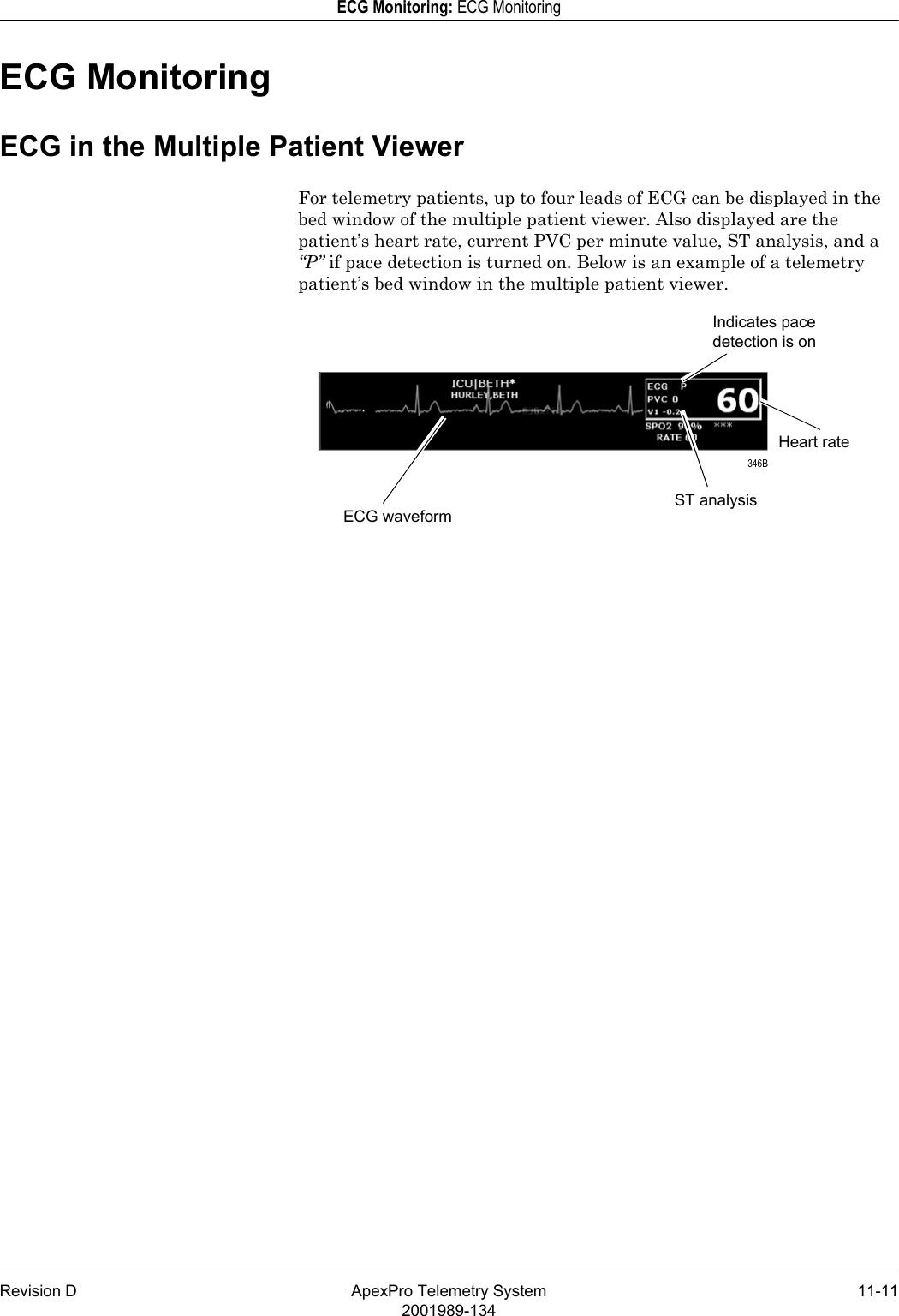 Revision D ApexPro Telemetry System 11-112001989-134ECG Monitoring: ECG MonitoringECG MonitoringECG in the Multiple Patient ViewerFor telemetry patients, up to four leads of ECG can be displayed in the bed window of the multiple patient viewer. Also displayed are the patient’s heart rate, current PVC per minute value, ST analysis, and a “P” if pace detection is turned on. Below is an example of a telemetry patient’s bed window in the multiple patient viewer.Heart rateIndicates pace detection is onST analysisECG waveform 346B