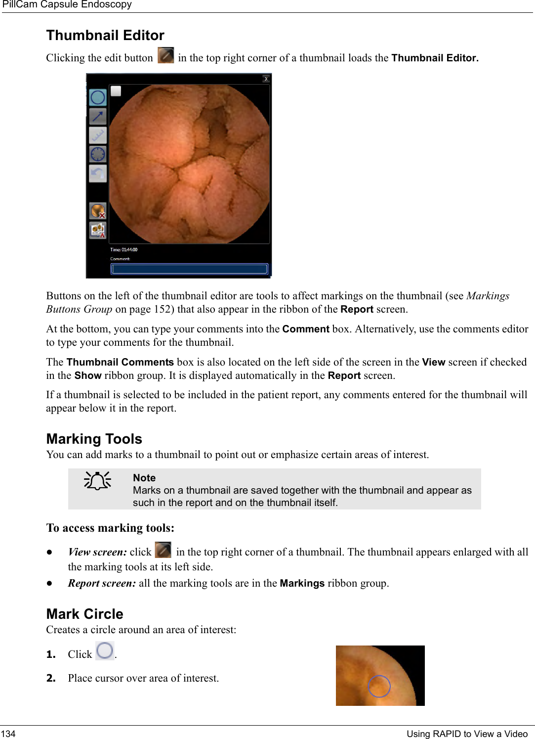 PillCam Capsule Endoscopy134 Using RAPID to View a VideoThumbnail EditorClicking the edit button   in the top right corner of a thumbnail loads the Thumbnail Editor.Buttons on the left of the thumbnail editor are tools to affect markings on the thumbnail (see Markings Buttons Group on page 152) that also appear in the ribbon of the Report screen.At the bottom, you can type your comments into the Comment box. Alternatively, use the comments editor to type your comments for the thumbnail. The Thumbnail Comments box is also located on the left side of the screen in the View screen if checked in the Show ribbon group. It is displayed automatically in the Report screen. If a thumbnail is selected to be included in the patient report, any comments entered for the thumbnail will appear below it in the report.Marking ToolsYou can add marks to a thumbnail to point out or emphasize certain areas of interest.  To access marking tools:•View screen: click   in the top right corner of a thumbnail. The thumbnail appears enlarged with all the marking tools at its left side.•Report screen: all the marking tools are in the Markings ribbon group.Mark Circle Creates a circle around an area of interest:1. Click  .2. Place cursor over area of interest. ֠֠֠֠NoteMarks on a thumbnail are saved together with the thumbnail and appear as such in the report and on the thumbnail itself.
