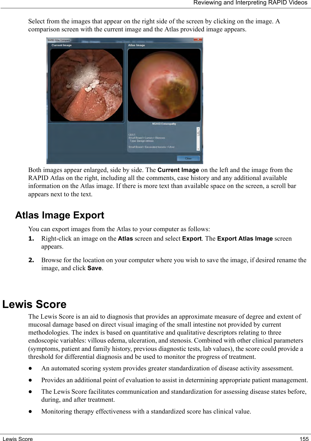 Reviewing and Interpreting RAPID VideosLewis Score 155Select from the images that appear on the right side of the screen by clicking on the image. A comparison screen with the current image and the Atlas provided image appears.Both images appear enlarged, side by side. The Current Image on the left and the image from the RAPID Atlas on the right, including all the comments, case history and any additional available information on the Atlas image. If there is more text than available space on the screen, a scroll bar appears next to the text.Atlas Image Export You can export images from the Atlas to your computer as follows:1. Right-click an image on the Atlas screen and select Export. The Export Atlas Image screen appears.2. Browse for the location on your computer where you wish to save the image, if desired rename the image, and click Save.Lewis Score The Lewis Score is an aid to diagnosis that provides an approximate measure of degree and extent of mucosal damage based on direct visual imaging of the small intestine not provided by current methodologies. The index is based on quantitative and qualitative descriptors relating to three endoscopic variables: villous edema, ulceration, and stenosis. Combined with other clinical parameters (symptoms, patient and family history, previous diagnostic tests, lab values), the score could provide a threshold for differential diagnosis and be used to monitor the progress of treatment.•An automated scoring system provides greater standardization of disease activity assessment.•Provides an additional point of evaluation to assist in determining appropriate patient management.•The Lewis Score facilitates communication and standardization for assessing disease states before, during, and after treatment.•Monitoring therapy effectiveness with a standardized score has clinical value.
