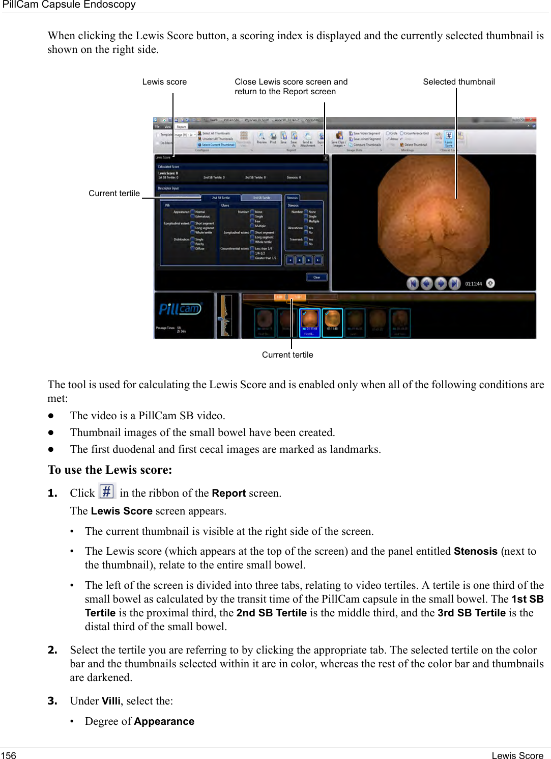 PillCam Capsule Endoscopy156 Lewis ScoreWhen clicking the Lewis Score button, a scoring index is displayed and the currently selected thumbnail is shown on the right side. The tool is used for calculating the Lewis Score and is enabled only when all of the following conditions are met: •The video is a PillCam SB video.•Thumbnail images of the small bowel have been created.•The first duodenal and first cecal images are marked as landmarks.To use the Lewis score:1. Click   in the ribbon of the Report screen.The Lewis Score screen appears.• The current thumbnail is visible at the right side of the screen.• The Lewis score (which appears at the top of the screen) and the panel entitled Stenosis (next to the thumbnail), relate to the entire small bowel.• The left of the screen is divided into three tabs, relating to video tertiles. A tertile is one third of the small bowel as calculated by the transit time of the PillCam capsule in the small bowel. The 1st SB Tertile is the proximal third, the 2nd SB Tertile is the middle third, and the 3rd SB Tertile is the distal third of the small bowel.2. Select the tertile you are referring to by clicking the appropriate tab. The selected tertile on the color bar and the thumbnails selected within it are in color, whereas the rest of the color bar and thumbnails are darkened.3. Under Villi, select the:• Degree of AppearanceLewis score Selected thumbnailClose Lewis score screen and return to the Report screenCurrent tertileCurrent tertile