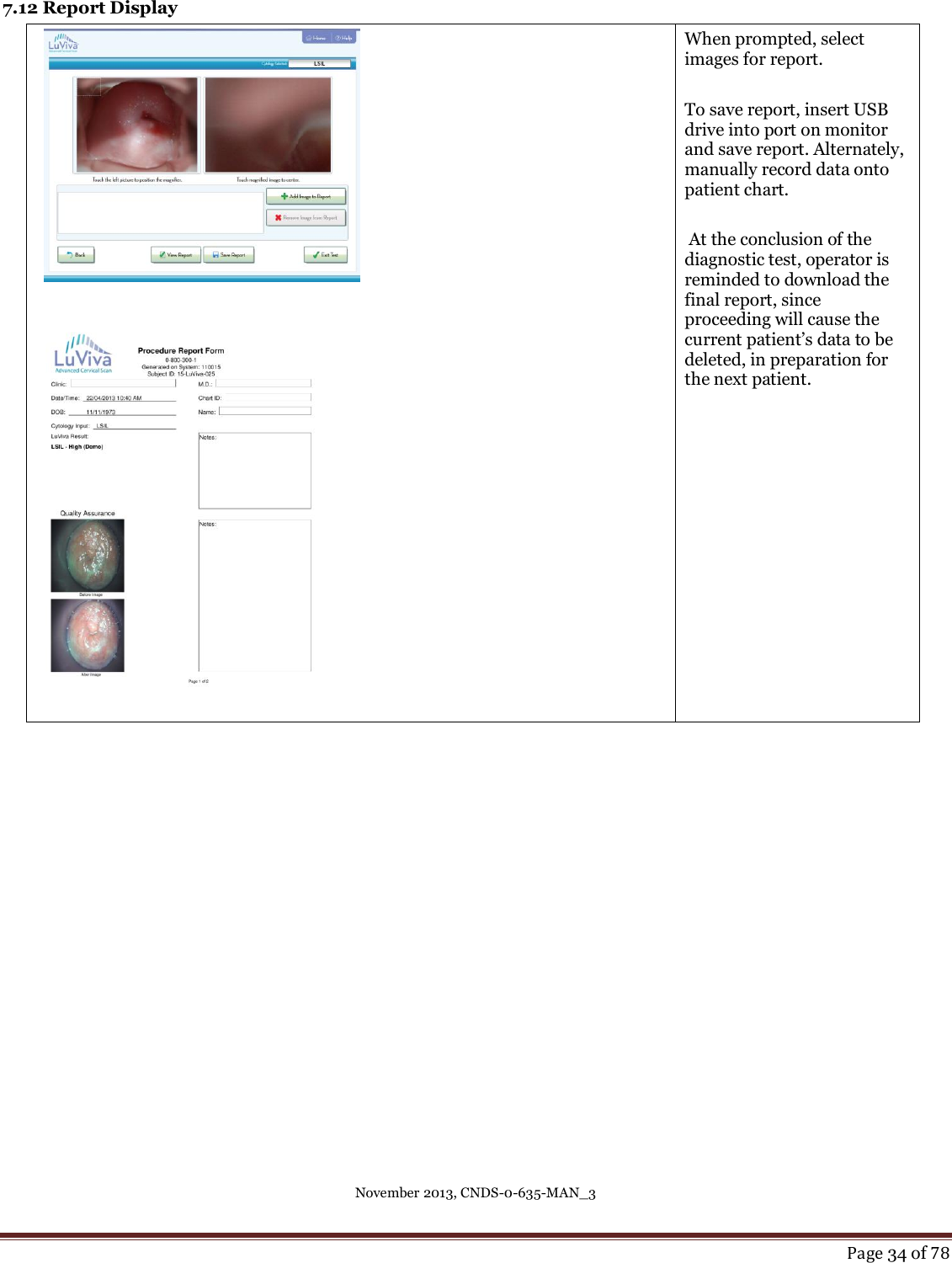 November 2013, CNDS-0-635-MAN_3     Page 34 of 78  7.12 Report Display                         When prompted, select images for report.   To save report, insert USB drive into port on monitor and save report. Alternately, manually record data onto patient chart.   At the conclusion of the diagnostic test, operator is reminded to download the final report, since proceeding will cause the current patient’s data to be deleted, in preparation for the next patient.    