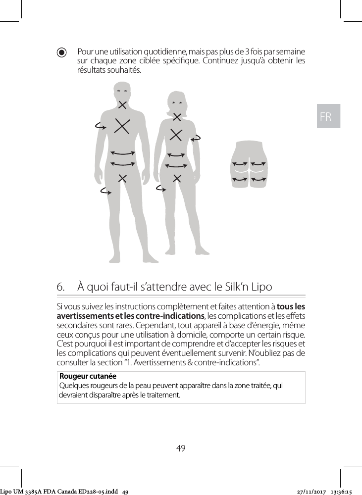 FRFR49 UPour une utilisation quotidienne, mais pas plus de 3 fois par semaine sur chaque zone ciblée spécique. Continuez jusqu’à obtenir les résultats souhaités.6.  À quoi faut-il s’attendre avec le Silk’n LipoSi vous suivez les instructions complètement et faites attention à tous les avertissements et les contre-indications, les complications et les eets secondaires sont rares. Cependant, tout appareil à base d’énergie, même ceux conçus pour une utilisation à domicile, comporte un certain risque. C’est pourquoi il est important de comprendre et d’accepter les risques et les complications qui peuvent éventuellement survenir. N’oubliez pas de consulter la section “1. Avertissements &amp; contre-indications”.Rougeur cutanéeQuelques rougeurs de la peau peuvent apparaître dans la zone traitée, qui devraient disparaître après le traitement. Lipo UM 3385A FDA Canada ED228-05.indd   49 27/11/2017   13:36:15