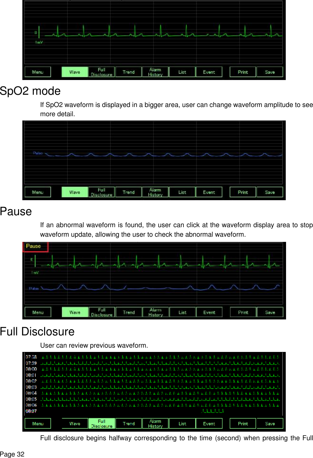    Page 32  SpO2 mode  If SpO2 waveform is displayed in a bigger area, user can change waveform amplitude to see more detail.  Pause If an abnormal waveform is found, the user can click at the waveform display area to stop waveform update, allowing the user to check the abnormal waveform.  Full Disclosure User can review previous waveform.  Full disclosure begins halfway corresponding to the time (second) when pressing the Full 