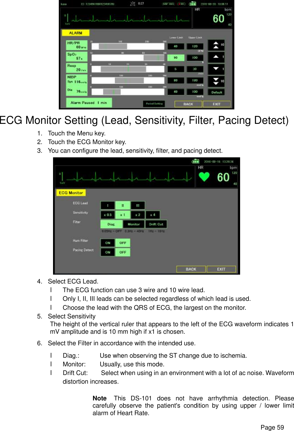      Page 59  ECG Monitor Setting (Lead, Sensitivity, Filter, Pacing Detect) 1. Touch the Menu key. 2. Touch the ECG Monitor key. 3. You can configure the lead, sensitivity, filter, and pacing detect.  4. Select ECG Lead. l The ECG function can use 3 wire and 10 wire lead. l Only I, II, III leads can be selected regardless of which lead is used. l Choose the lead with the QRS of ECG, the largest on the monitor. 5. Select Sensitivity The height of the vertical ruler that appears to the left of the ECG waveform indicates 1 mV amplitude and is 10 mm high if x1 is chosen. 6. Select the Filter in accordance with the intended use. l Diag.:  Use when observing the ST change due to ischemia. l Monitor: Usually, use this mode. l Drift Cut: Select when using in an environment with a lot of ac noise. Waveform       distortion increases.  Note  This DS-101 does not have arrhythmia detection. Please carefully observe the patient&apos;s condition by using upper / lower limit alarm of Heart Rate. 
