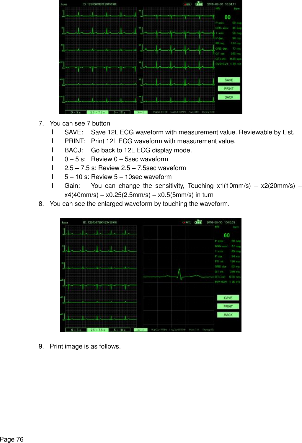    Page 76  7. You can see 7 button l SAVE: Save 12L ECG waveform with measurement value. Reviewable by List. l PRINT: Print 12L ECG waveform with measurement value. l BACJ: Go back to 12L ECG display mode. l 0 – 5 s: Review 0 – 5sec waveform l 2.5 – 7.5 s: Review 2.5 – 7.5sec waveform l 5 – 10 s: Review 5 – 10sec waveform l Gain: You can change the sensitivity, Touching x1(10mm/s)  – x2(20mm/s)  – x4(40mm/s) – x0.25(2.5mm/s) – x0.5(5mm/s) in turn 8. You can see the enlarged waveform by touching the waveform.    9. Print image is as follows. 