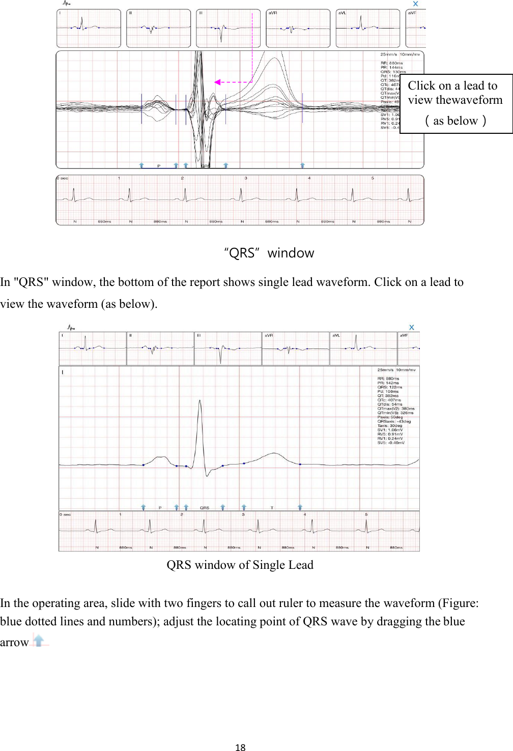 18     “QRS”window In &quot;QRS&quot; window, the bottom of the report shows single lead waveform. Click on a lead to view the waveform (as below). QRS window of Single Lead  In the operating area, slide with two fingers to call out ruler to measure the waveform (Figure: blue dotted lines and numbers); adjust the locating point of QRS wave by dragging the blue arrow Click on a lead to view thewaveform （as below） 