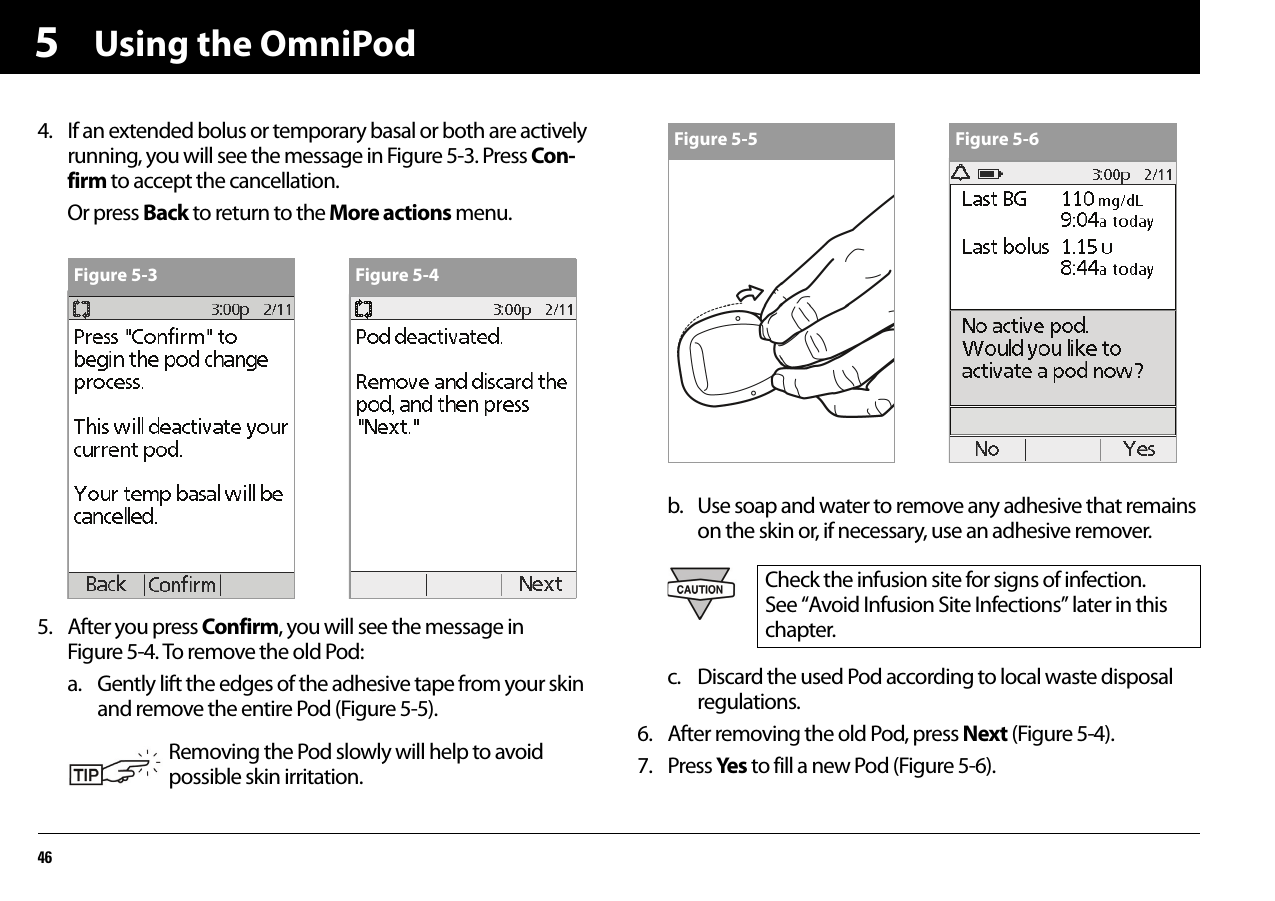 Using the OmniPod4654. If an extended bolus or temporary basal or both are actively running, you will see the message in Figure 5-3. Press Con-firm to accept the cancellation.Or press Back to return to the More actions menu.5. After you press Confirm, you will see the message inFigure 5-4. To remove the old Pod:a. Gently lift the edges of the adhesive tape from your skin and remove the entire Pod (Figure 5-5).b. Use soap and water to remove any adhesive that remains on the skin or, if necessary, use an adhesive remover.c. Discard the used Pod according to local waste disposal regulations.6. After removing the old Pod, press Next (Figure 5-4).7. Press Yes to fill a new Pod (Figure 5-6).Removing the Pod slowly will help to avoid possible skin irritation.Figure 5-3 Figure 5-4Check the infusion site for signs of infection. See “Avoid Infusion Site Infections” later in this chapter.Figure 5-5 Figure 5-6
