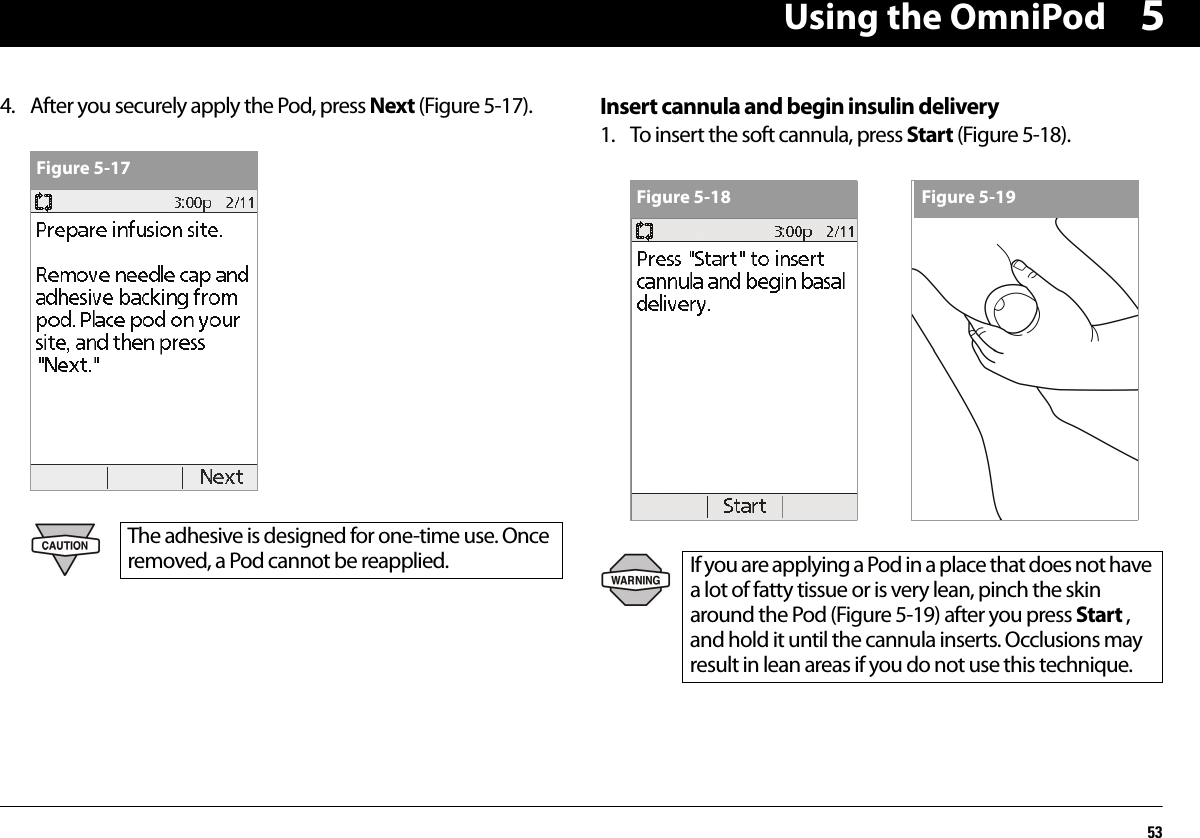 Using the OmniPod5354. After you securely apply the Pod, press Next (Figure 5-17). Insert cannula and begin insulin delivery1. To insert the soft cannula, press Start (Figure 5-18).The adhesive is designed for one-time use. Once removed, a Pod cannot be reapplied.Figure 5-17If you are applying a Pod in a place that does not have a lot of fatty tissue or is very lean, pinch the skin around the Pod (Figure 5-19) after you press Start , and hold it until the cannula inserts. Occlusions may result in lean areas if you do not use this technique.Figure 5-18 Figure 5-19