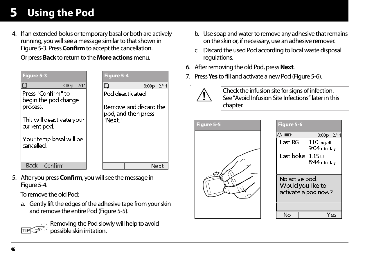 Using the Pod4654. If an extended bolus or temporary basal or both are actively running, you will see a message similar to that shown in Figure 5-3. Press Confirm to accept the cancellation.Or press Back to return to the More actions menu.5. After you press Confirm, you will see the message inFigure 5-4.To remove the old Pod:a. Gently lift the edges of the adhesive tape from your skin and remove the entire Pod (Figure 5-5). b. Use soap and water to remove any adhesive that remains on the skin or, if necessary, use an adhesive remover.c. Discard the used Pod according to local waste disposal regulations.6. After removing the old Pod, press Next.7. Press Yes  to fill and activate a new Pod (Figure 5-6)..Removing the Pod slowly will help to avoid possible skin irritation.Figure 5-3 Figure 5-4Check the infusion site for signs of infection. See “Avoid Infusion Site Infections” later in this chapter.Figure 5-5 Figure 5-6