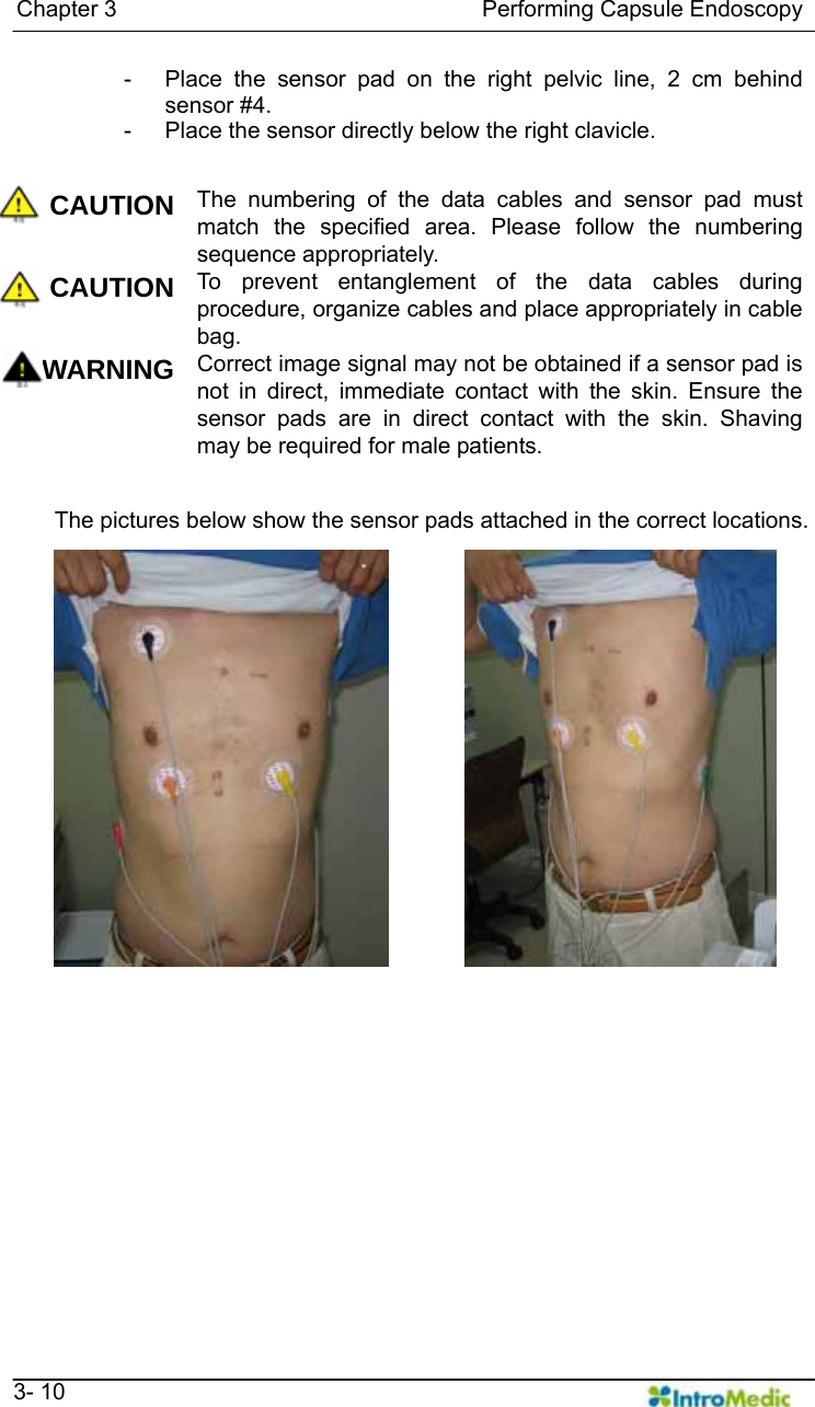   Chapter 3                                Performing Capsule Endoscopy   3- 10 -  Place the sensor pad on the right pelvic line, 2 cm behind sensor #4. -  Place the sensor directly below the right clavicle.  CAUTION The numbering of the data cables and sensor pad must match the specified area. Please follow the numbering sequence appropriately.   CAUTION To prevent entanglement of the data cables during procedure, organize cables and place appropriately in cable bag. WARNING Correct image signal may not be obtained if a sensor pad is not in direct, immediate contact with the skin. Ensure the sensor pads are in direct contact with the skin. Shaving may be required for male patients.    The pictures below show the sensor pads attached in the correct locations.      