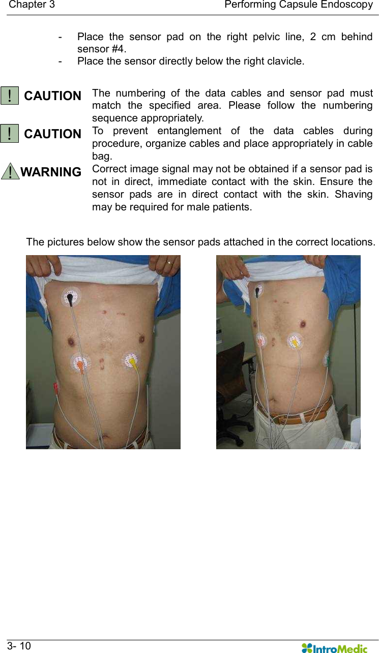   Chapter 3                                                                Performing Capsule Endoscopy   3- 10 -  Place  the  sensor  pad  on  the  right  pelvic  line,  2  cm  behind sensor #4. -  Place the sensor directly below the right clavicle.  CAUTION The  numbering  of  the  data  cables  and  sensor  pad  must match  the  specified  area.  Please  follow  the  numbering sequence appropriately.   CAUTION  To  prevent  entanglement  of  the  data  cables  during procedure, organize cables and place appropriately in cable bag. WARNING  Correct image signal may not be obtained if a sensor pad is not  in  direct,  immediate  contact  with  the  skin.  Ensure  the sensor  pads  are  in  direct  contact  with  the  skin.  Shaving may be required for male patients.    The pictures below show the sensor pads attached in the correct locations.       