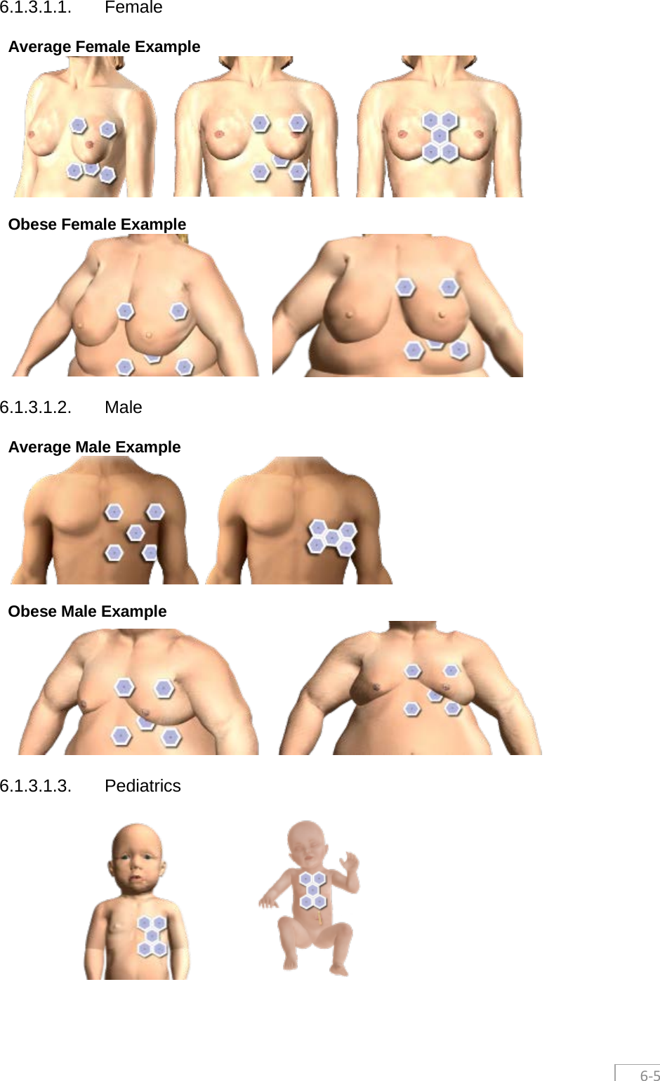  6-5 6.1.3.1.1. Female Average Female Example   Obese Female Example  6.1.3.1.2. Male Average Male Example   Obese Male Example  6.1.3.1.3. Pediatrics     