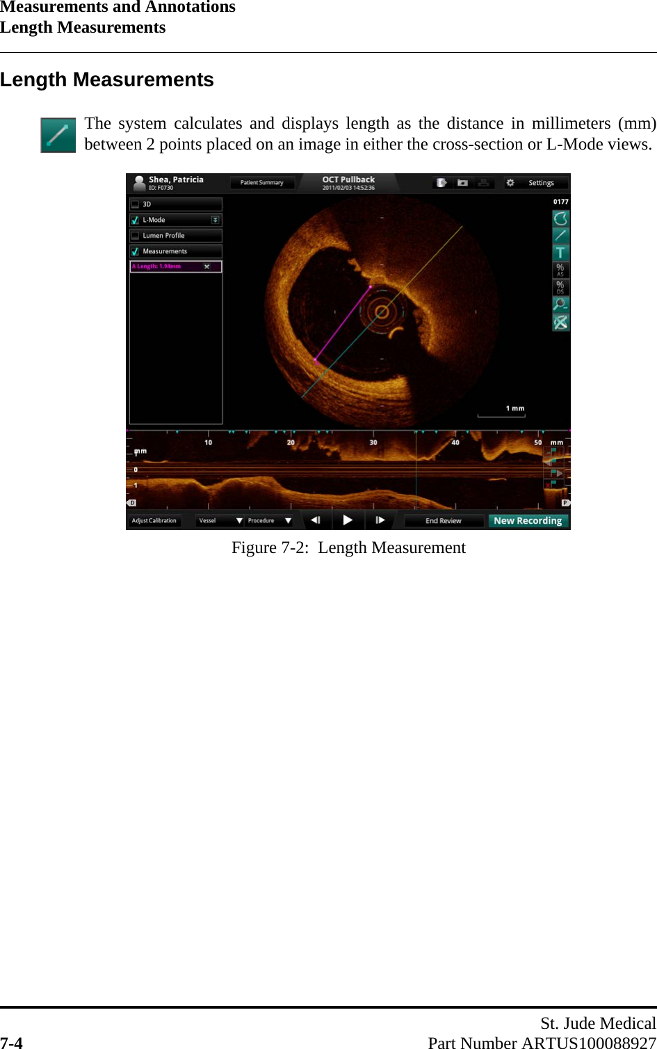 Measurements and AnnotationsLength MeasurementsSt. Jude Medical7-4 Part Number ARTUS100088927Length MeasurementsThe system calculates and displays length as the distance in millimeters (mm)between 2 points placed on an image in either the cross-section or L-Mode views.Figure 7-2:  Length Measurement