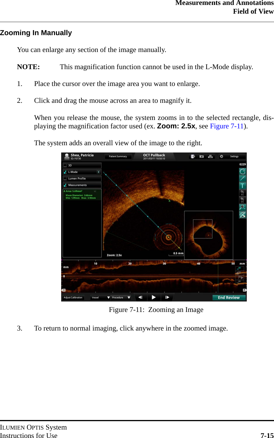 Measurements and AnnotationsField of ViewILUMIEN OPTIS SystemInstructions for Use 7-15Zooming In ManuallyYou can enlarge any section of the image manually.NOTE: This magnification function cannot be used in the L-Mode display.1. Place the cursor over the image area you want to enlarge.2. Click and drag the mouse across an area to magnify it. When you release the mouse, the system zooms in to the selected rectangle, dis-playing the magnification factor used (ex. Zoom: 2.5x, see Figure 7-11). The system adds an overall view of the image to the right.3. To return to normal imaging, click anywhere in the zoomed image.Figure 7-11:  Zooming an Image