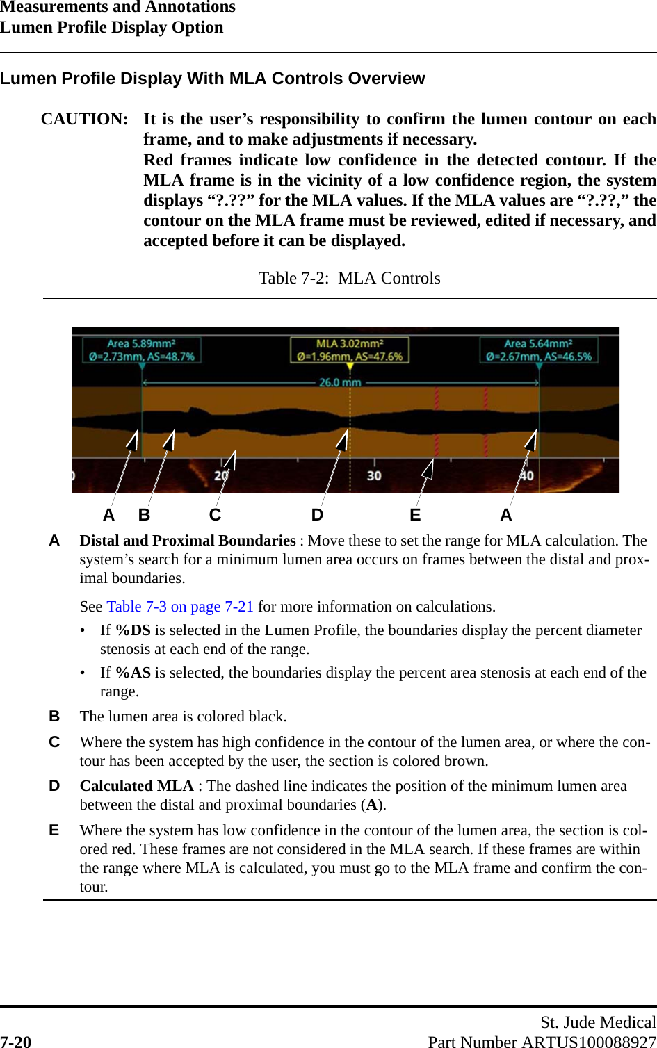 Measurements and AnnotationsLumen Profile Display OptionSt. Jude Medical7-20 Part Number ARTUS100088927Lumen Profile Display With MLA Controls OverviewCAUTION: It is the user’s responsibility to confirm the lumen contour on eachframe, and to make adjustments if necessary.  Red frames indicate low confidence in the detected contour. If theMLA frame is in the vicinity of a low confidence region, the systemdisplays “?.??” for the MLA values. If the MLA values are “?.??,” thecontour on the MLA frame must be reviewed, edited if necessary, andaccepted before it can be displayed.Table 7-2:  MLA ControlsADistal and Proximal Boundaries : Move these to set the range for MLA calculation. The system’s search for a minimum lumen area occurs on frames between the distal and prox-imal boundaries.See Table 7-3 on page 7-21 for more information on calculations.• If %DS is selected in the Lumen Profile, the boundaries display the percent diameter stenosis at each end of the range.• If %AS is selected, the boundaries display the percent area stenosis at each end of the range.BThe lumen area is colored black.CWhere the system has high confidence in the contour of the lumen area, or where the con-tour has been accepted by the user, the section is colored brown.DCalculated MLA : The dashed line indicates the position of the minimum lumen area between the distal and proximal boundaries (A).EWhere the system has low confidence in the contour of the lumen area, the section is col-ored red. These frames are not considered in the MLA search. If these frames are within the range where MLA is calculated, you must go to the MLA frame and confirm the con-tour.BCEA D A
