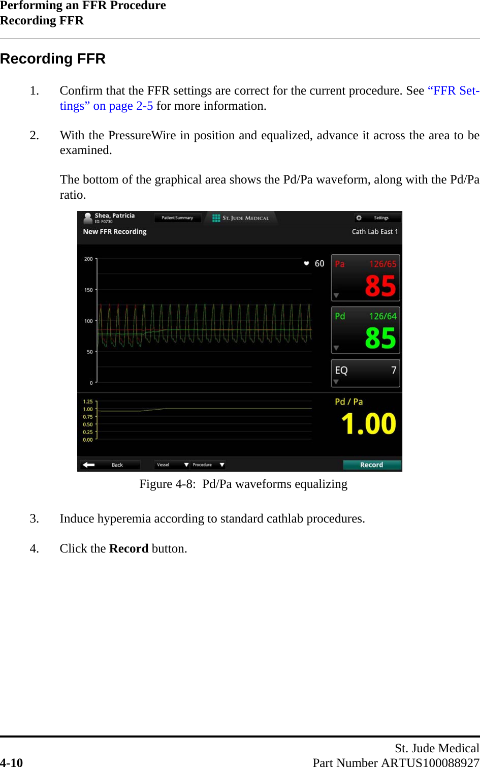 Performing an FFR ProcedureRecording FFRSt. Jude Medical4-10 Part Number ARTUS100088927Recording FFR1. Confirm that the FFR settings are correct for the current procedure. See “FFR Set-tings” on page 2-5 for more information.2. With the PressureWire in position and equalized, advance it across the area to beexamined.The bottom of the graphical area shows the Pd/Pa waveform, along with the Pd/Paratio.3. Induce hyperemia according to standard cathlab procedures.4. Click the Record button.Figure 4-8:  Pd/Pa waveforms equalizing