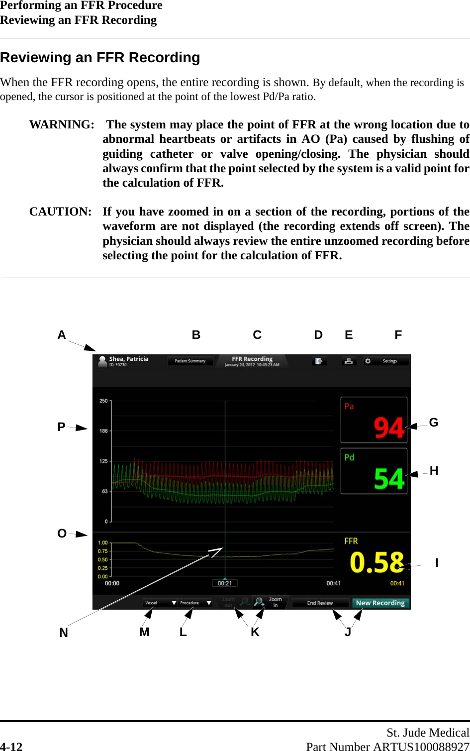 Performing an FFR ProcedureReviewing an FFR RecordingSt. Jude Medical4-12 Part Number ARTUS100088927Reviewing an FFR RecordingWhen the FFR recording opens, the entire recording is shown. By default, when the recording is opened, the cursor is positioned at the point of the lowest Pd/Pa ratio.WARNING:  The system may place the point of FFR at the wrong location due toabnormal heartbeats or artifacts in AO (Pa) caused by flushing ofguiding catheter or valve opening/closing. The physician shouldalways confirm that the point selected by the system is a valid point forthe calculation of FFR.CAUTION: If you have zoomed in on a section of the recording, portions of thewaveform are not displayed (the recording extends off screen). Thephysician should always review the entire unzoomed recording beforeselecting the point for the calculation of FFR.PHGIOKJNABDFCLME