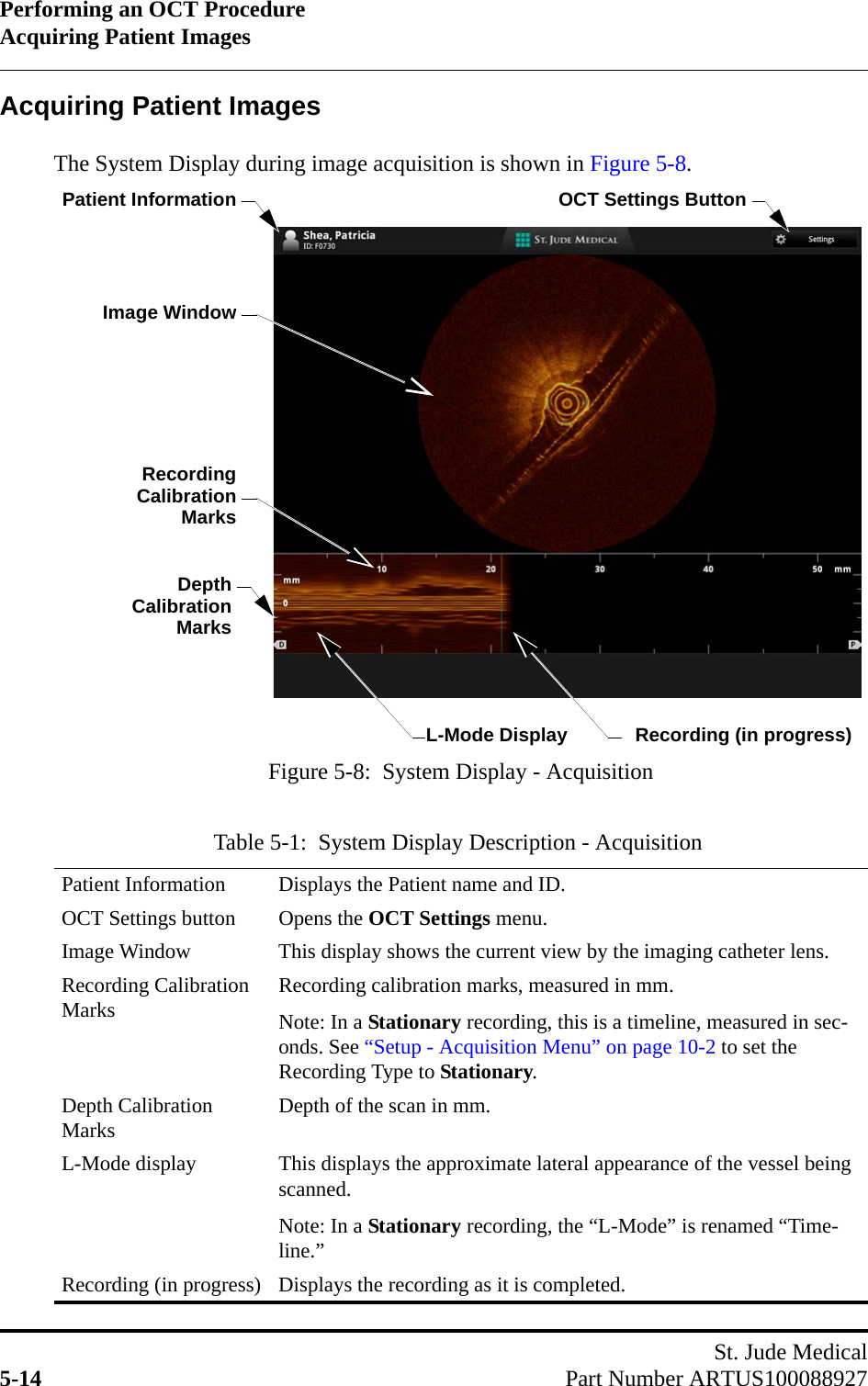Performing an OCT ProcedureAcquiring Patient ImagesSt. Jude Medical5-14 Part Number ARTUS100088927Acquiring Patient ImagesThe System Display during image acquisition is shown in Figure 5-8.Table 5-1:  System Display Description - AcquisitionPatient Information Displays the Patient name and ID.OCT Settings button Opens the OCT Settings menu.Image Window This display shows the current view by the imaging catheter lens.Recording Calibration Marks Recording calibration marks, measured in mm. Note: In a Stationary recording, this is a timeline, measured in sec-onds. See “Setup - Acquisition Menu” on page 10-2 to set the Recording Type to Stationary.Depth Calibration Marks Depth of the scan in mm.L-Mode display This displays the approximate lateral appearance of the vessel being scanned.Note: In a Stationary recording, the “L-Mode” is renamed “Time-line.”Recording (in progress) Displays the recording as it is completed.Recording (in progress)RecordingCalibrationMarksL-Mode Display Figure 5-8:  System Display - AcquisitionImage WindowDepthPatient InformationCalibrationMarksOCT Settings Button