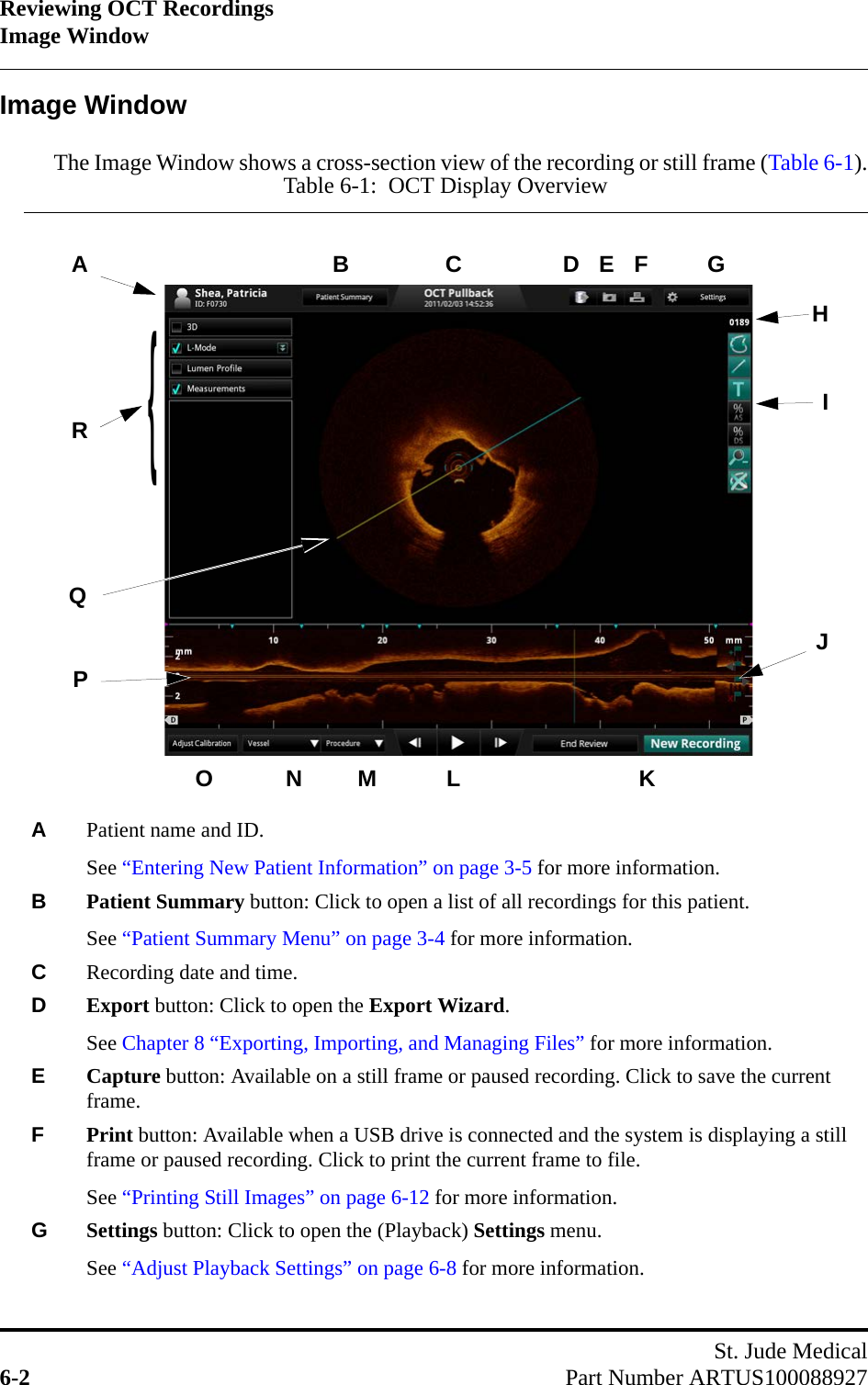 Reviewing OCT RecordingsImage WindowSt. Jude Medical6-2 Part Number ARTUS100088927Image WindowThe Image Window shows a cross-section view of the recording or still frame (Table 6-1).Table 6-1:  OCT Display OverviewAPatient name and ID. See “Entering New Patient Information” on page 3-5 for more information.BPatient Summary button: Click to open a list of all recordings for this patient.See “Patient Summary Menu” on page 3-4 for more information.CRecording date and time.DExport button: Click to open the Export Wizard.See Chapter 8 “Exporting, Importing, and Managing Files” for more information.ECapture button: Available on a still frame or paused recording. Click to save the current frame.FPrint button: Available when a USB drive is connected and the system is displaying a still frame or paused recording. Click to print the current frame to file.See “Printing Still Images” on page 6-12 for more information.GSettings button: Click to open the (Playback) Settings menu.See “Adjust Playback Settings” on page 6-8 for more information.AB EGHIJLPRCDMNOKQF{