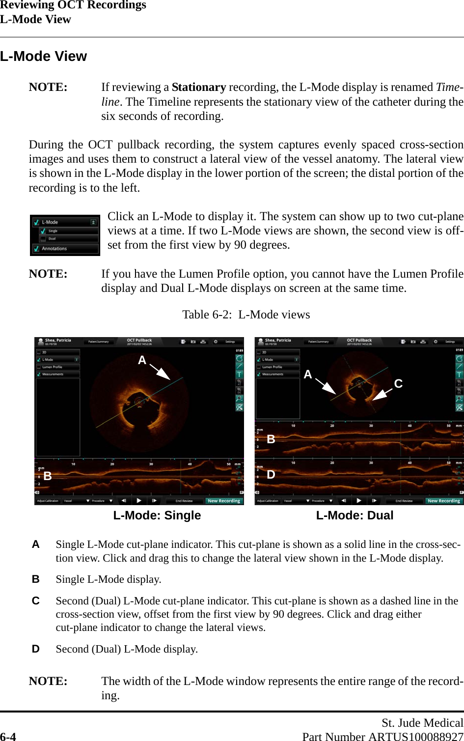 Reviewing OCT RecordingsL-Mode ViewSt. Jude Medical6-4 Part Number ARTUS100088927L-Mode ViewNOTE: If reviewing a Stationary recording, the L-Mode display is renamed Time-line. The Timeline represents the stationary view of the catheter during thesix seconds of recording.During the OCT pullback recording, the system captures evenly spaced cross-sectionimages and uses them to construct a lateral view of the vessel anatomy. The lateral viewis shown in the L-Mode display in the lower portion of the screen; the distal portion of therecording is to the left.Click an L-Mode to display it. The system can show up to two cut-planeviews at a time. If two L-Mode views are shown, the second view is off-set from the first view by 90 degrees. NOTE: If you have the Lumen Profile option, you cannot have the Lumen Profiledisplay and Dual L-Mode displays on screen at the same time.NOTE: The width of the L-Mode window represents the entire range of the record-ing.Table 6-2:  L-Mode viewsASingle L-Mode cut-plane indicator. This cut-plane is shown as a solid line in the cross-sec-tion view. Click and drag this to change the lateral view shown in the L-Mode display.BSingle L-Mode display.CSecond (Dual) L-Mode cut-plane indicator. This cut-plane is shown as a dashed line in the cross-section view, offset from the first view by 90 degrees. Click and drag either cut-plane indicator to change the lateral views.DSecond (Dual) L-Mode display.CBBADL-Mode: Single L-Mode: DualA