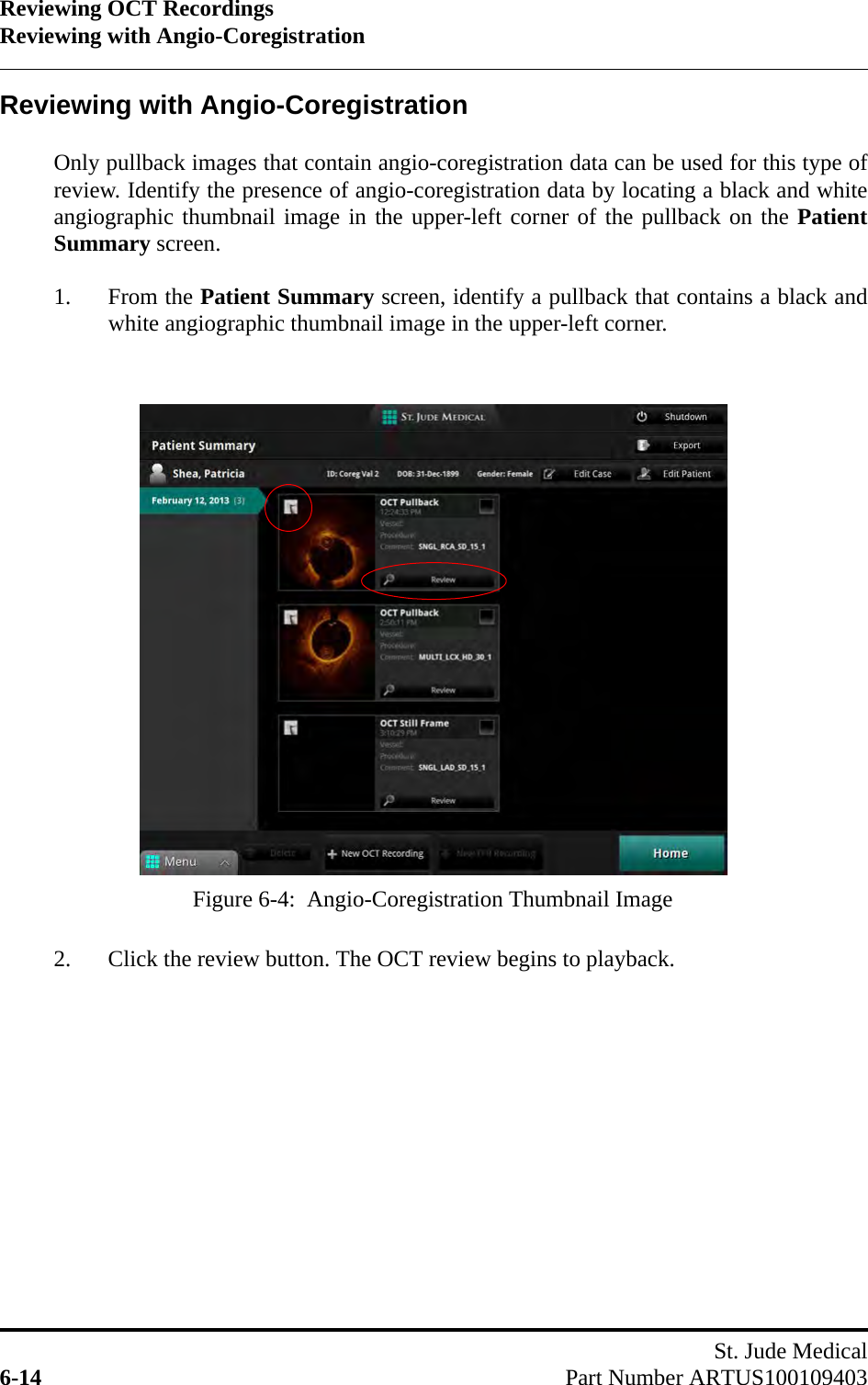 Reviewing OCT RecordingsReviewing with Angio-CoregistrationSt. Jude Medical6-14 Part Number ARTUS100109403Reviewing with Angio-CoregistrationOnly pullback images that contain angio-coregistration data can be used for this type ofreview. Identify the presence of angio-coregistration data by locating a black and whiteangiographic thumbnail image in the upper-left corner of the pullback on the PatientSummary screen. 1. From the Patient Summary screen, identify a pullback that contains a black andwhite angiographic thumbnail image in the upper-left corner.2. Click the review button. The OCT review begins to playback. Figure 6-4:  Angio-Coregistration Thumbnail Image