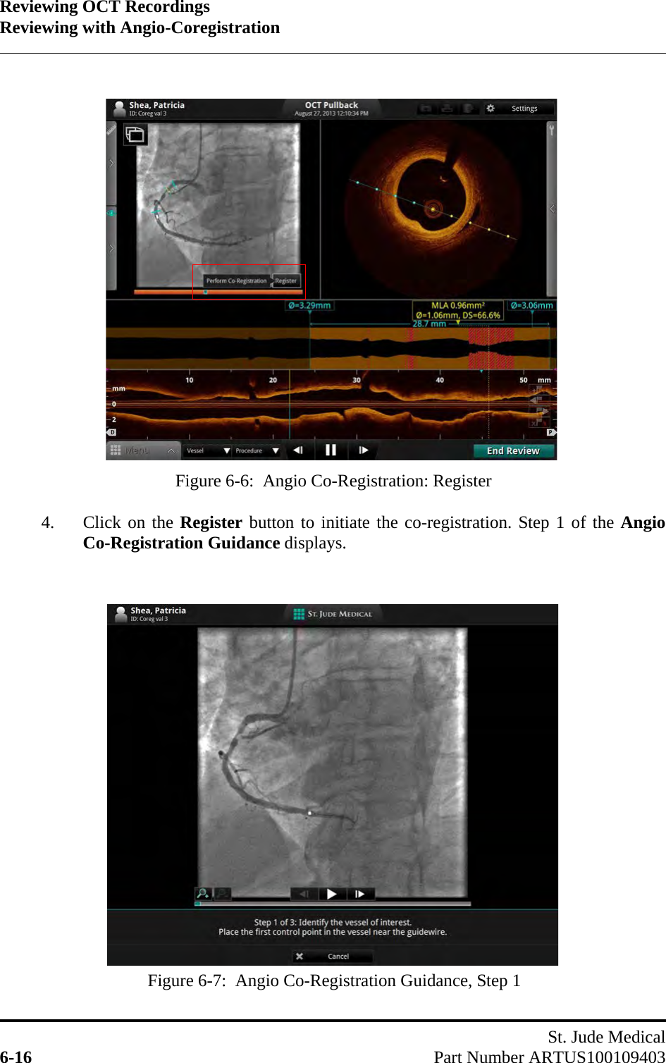 Reviewing OCT RecordingsReviewing with Angio-CoregistrationSt. Jude Medical6-16 Part Number ARTUS1001094034. Click on the Register button to initiate the co-registration. Step 1 of the AngioCo-Registration Guidance displays.Figure 6-6:  Angio Co-Registration: RegisterFigure 6-7:  Angio Co-Registration Guidance, Step 1