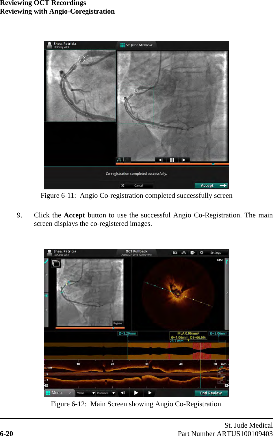 Reviewing OCT RecordingsReviewing with Angio-CoregistrationSt. Jude Medical6-20 Part Number ARTUS1001094039. Click the Accept button to use the successful Angio Co-Registration. The mainscreen displays the co-registered images.Figure 6-11:  Angio Co-registration completed successfully screenFigure 6-12:  Main Screen showing Angio Co-Registration