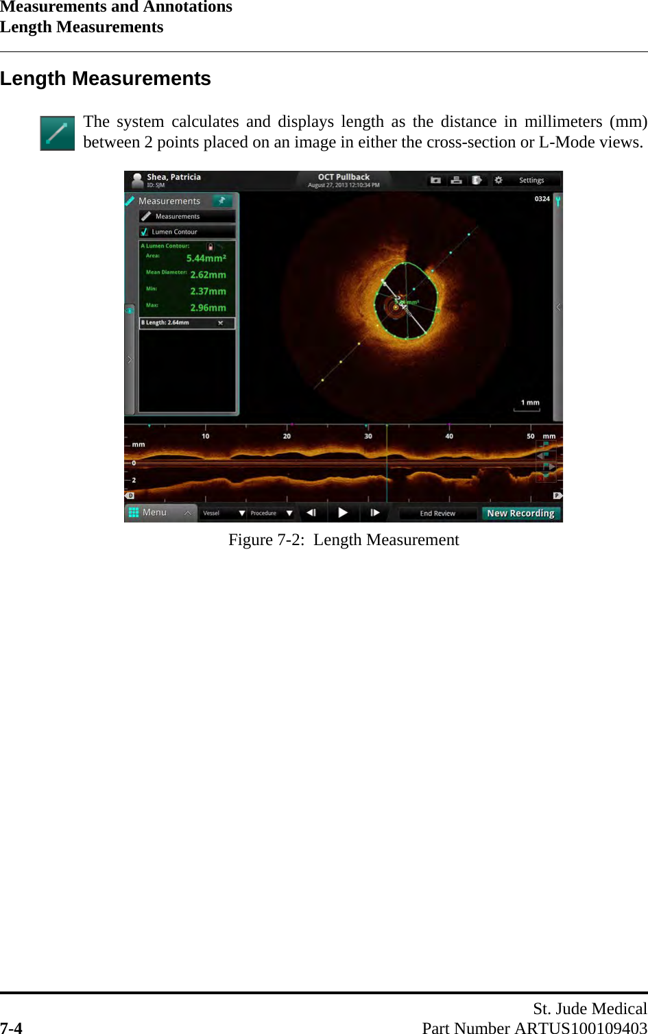 Measurements and AnnotationsLength MeasurementsSt. Jude Medical7-4 Part Number ARTUS100109403Length MeasurementsThe system calculates and displays length as the distance in millimeters (mm)between 2 points placed on an image in either the cross-section or L-Mode views.Figure 7-2:  Length Measurement