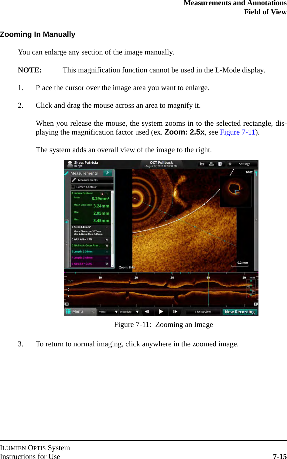 Measurements and AnnotationsField of ViewILUMIEN OPTIS SystemInstructions for Use 7-15Zooming In ManuallyYou can enlarge any section of the image manually.NOTE: This magnification function cannot be used in the L-Mode display.1. Place the cursor over the image area you want to enlarge.2. Click and drag the mouse across an area to magnify it. When you release the mouse, the system zooms in to the selected rectangle, dis-playing the magnification factor used (ex. Zoom: 2.5x, see Figure 7-11). The system adds an overall view of the image to the right.3. To return to normal imaging, click anywhere in the zoomed image.Figure 7-11:  Zooming an Image