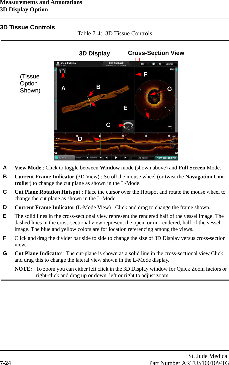 Measurements and Annotations3D Display OptionSt. Jude Medical7-24 Part Number ARTUS1001094033D Tissue Controls Table 7-4:  3D Tissue ControlsAView Mode : Click to toggle between Window mode (shown above) and Full Screen Mode.BCurrent Frame Indicator (3D View) : Scroll the mouse wheel (or twist the Navagation Con-troller) to change the cut plane as shown in the L-Mode.CCut Plane Rotation Hotspot : Place the cursor over the Hotspot and rotate the mouse wheel to change the cut plane as shown in the L-Mode.DCurrent Frame Indicator (L-Mode View) : Click and drag to change the frame shown.EThe solid lines in the cross-sectional view represent the rendered half of the vessel image. The dashed lines in the cross-sectional view represent the open, or un-rendered, half of the vessel image. The blue and yellow colors are for location referencing among the views.FClick and drag the divider bar side to side to change the size of 3D Display versus cross-section view.GCut Plane Indicator : The cut-plane is shown as a solid line in the cross-sectional view Click and drag this to change the lateral view shown in the L-Mode display.NOTE: To zoom you can either left click in the 3D Display window for Quick Zoom factors orright-click and drag up or down, left or right to adjust zoom.ACB3D Display Cross-Section View(TissueOptionShown)DFEG