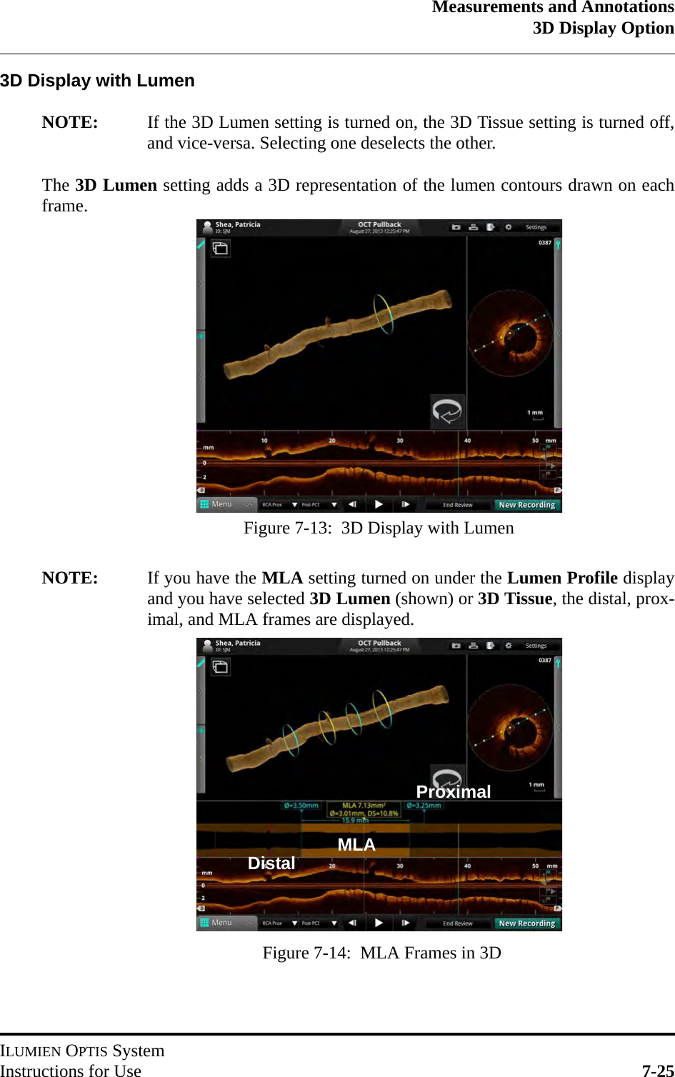 Measurements and Annotations3D Display OptionILUMIEN OPTIS SystemInstructions for Use 7-253D Display with LumenNOTE: If the 3D Lumen setting is turned on, the 3D Tissue setting is turned off,and vice-versa. Selecting one deselects the other.The 3D Lumen setting adds a 3D representation of the lumen contours drawn on eachframe.NOTE: If you have the MLA setting turned on under the Lumen Profile displayand you have selected 3D Lumen (shown) or 3D Tissue, the distal, prox-imal, and MLA frames are displayed.Figure 7-13:  3D Display with LumenFigure 7-14:  MLA Frames in 3DDistalProximalMLA