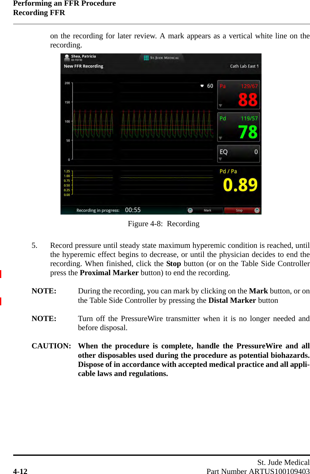 Performing an FFR ProcedureRecording FFRSt. Jude Medical4-12 Part Number ARTUS100109403on the recording for later review. A mark appears as a vertical white line on therecording.5. Record pressure until steady state maximum hyperemic condition is reached, untilthe hyperemic effect begins to decrease, or until the physician decides to end therecording. When finished, click the Stop button (or on the Table Side Controllerpress the Proximal Marker button) to end the recording.NOTE: During the recording, you can mark by clicking on the Mark button, or onthe Table Side Controller by pressing the Distal Marker buttonNOTE: Turn off the PressureWire transmitter when it is no longer needed andbefore disposal.CAUTION: When the procedure is complete, handle the PressureWire and allother disposables used during the procedure as potential biohazards.Dispose of in accordance with accepted medical practice and all appli-cable laws and regulations.Figure 4-8:  Recording