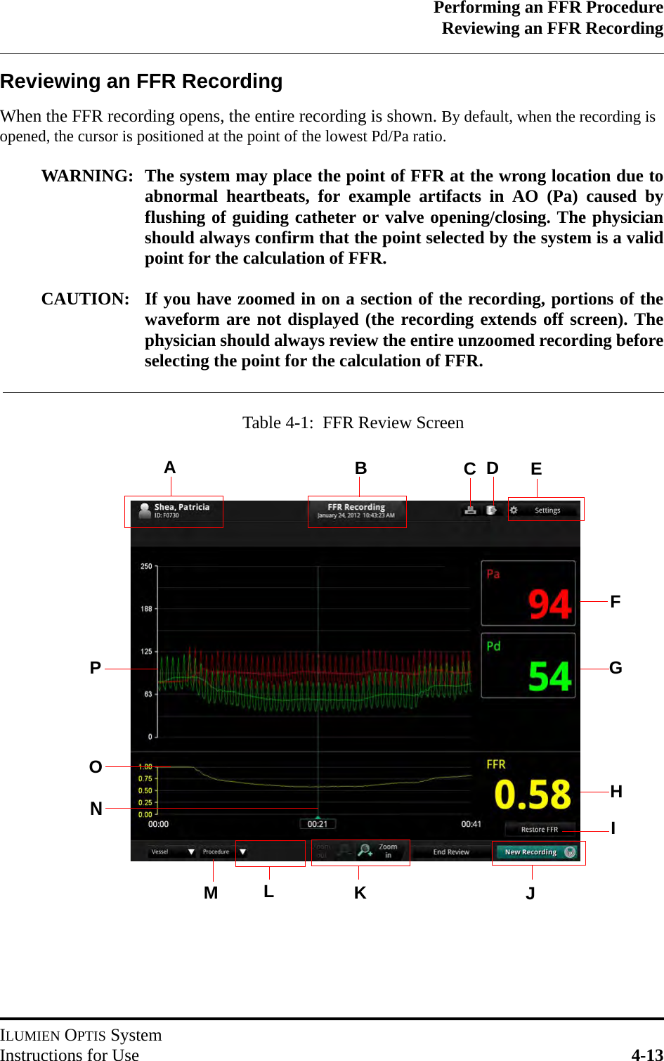 Performing an FFR ProcedureReviewing an FFR RecordingILUMIEN OPTIS SystemInstructions for Use 4-13Reviewing an FFR RecordingWhen the FFR recording opens, the entire recording is shown. By default, when the recording is opened, the cursor is positioned at the point of the lowest Pd/Pa ratio.WARNING: The system may place the point of FFR at the wrong location due toabnormal heartbeats, for example artifacts in AO (Pa) caused byflushing of guiding catheter or valve opening/closing. The physicianshould always confirm that the point selected by the system is a validpoint for the calculation of FFR.CAUTION: If you have zoomed in on a section of the recording, portions of thewaveform are not displayed (the recording extends off screen). Thephysician should always review the entire unzoomed recording beforeselecting the point for the calculation of FFR.PGFHOKJNACEBLMDTable 4-1:  FFR Review ScreenI