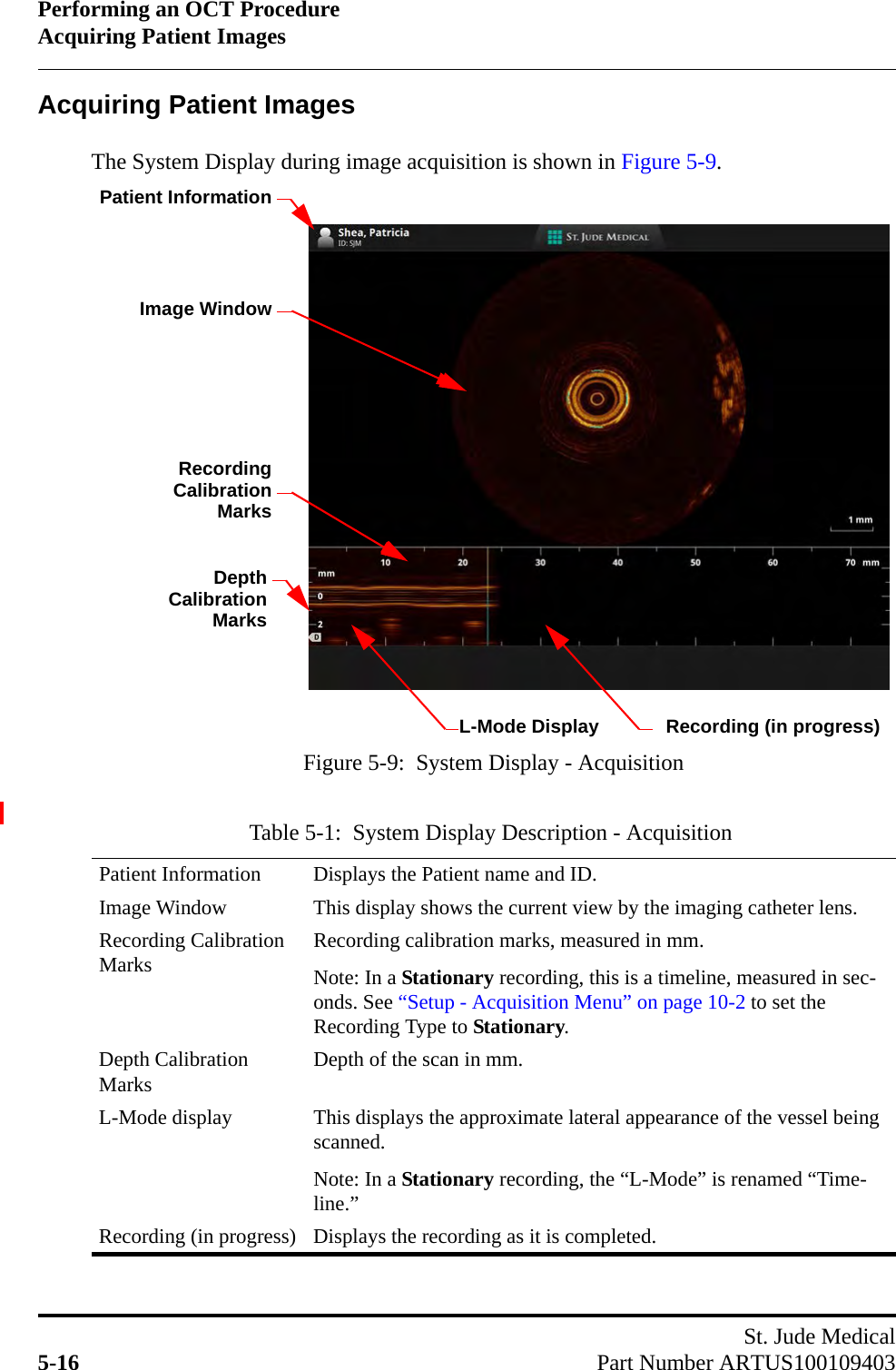 Performing an OCT ProcedureAcquiring Patient ImagesSt. Jude Medical5-16 Part Number ARTUS100109403Acquiring Patient ImagesThe System Display during image acquisition is shown in Figure 5-9.Table 5-1:  System Display Description - AcquisitionPatient Information Displays the Patient name and ID.Image Window This display shows the current view by the imaging catheter lens.Recording Calibration Marks Recording calibration marks, measured in mm. Note: In a Stationary recording, this is a timeline, measured in sec-onds. See “Setup - Acquisition Menu” on page 10-2 to set the Recording Type to Stationary.Depth Calibration Marks Depth of the scan in mm.L-Mode display This displays the approximate lateral appearance of the vessel being scanned.Note: In a Stationary recording, the “L-Mode” is renamed “Time-line.”Recording (in progress) Displays the recording as it is completed.Recording (in progress)RecordingCalibrationMarksL-Mode Display Figure 5-9:  System Display - AcquisitionImage WindowDepthPatient InformationCalibrationMarks