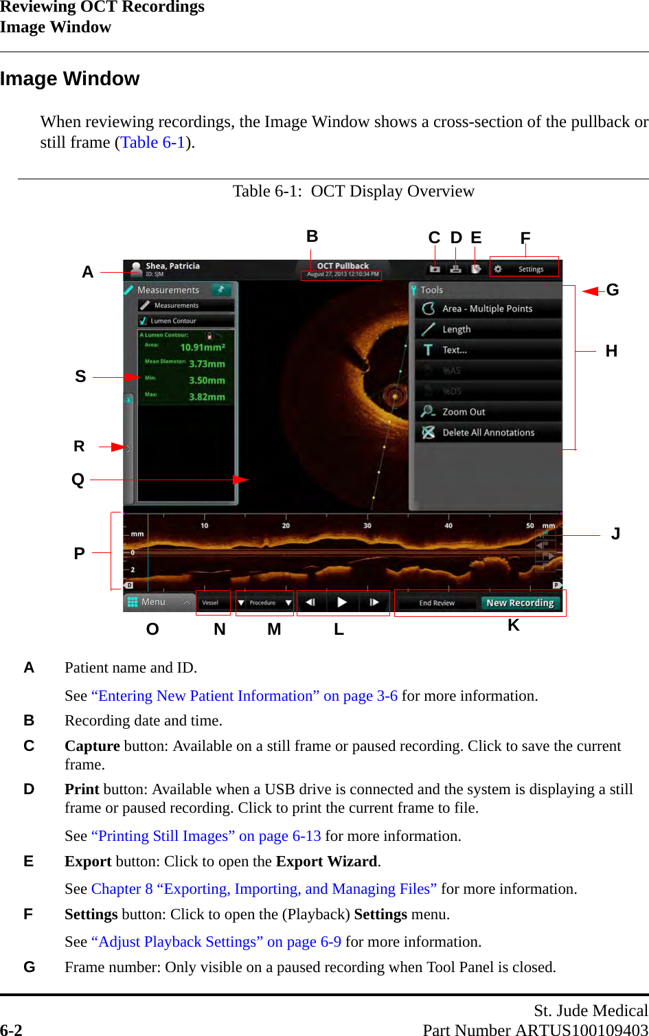 Reviewing OCT RecordingsImage WindowSt. Jude Medical6-2 Part Number ARTUS100109403Image WindowWhen reviewing recordings, the Image Window shows a cross-section of the pullback orstill frame (Table 6-1).Table 6-1:  OCT Display OverviewAPatient name and ID. See “Entering New Patient Information” on page 3-6 for more information.BRecording date and time.CCapture button: Available on a still frame or paused recording. Click to save the current frame.DPrint button: Available when a USB drive is connected and the system is displaying a still frame or paused recording. Click to print the current frame to file.See “Printing Still Images” on page 6-13 for more information.EExport button: Click to open the Export Wizard.See Chapter 8 “Exporting, Importing, and Managing Files” for more information.FSettings button: Click to open the (Playback) Settings menu.See “Adjust Playback Settings” on page 6-9 for more information.GFrame number: Only visible on a paused recording when Tool Panel is closed.ADFGHJLPSBCMNO KQER