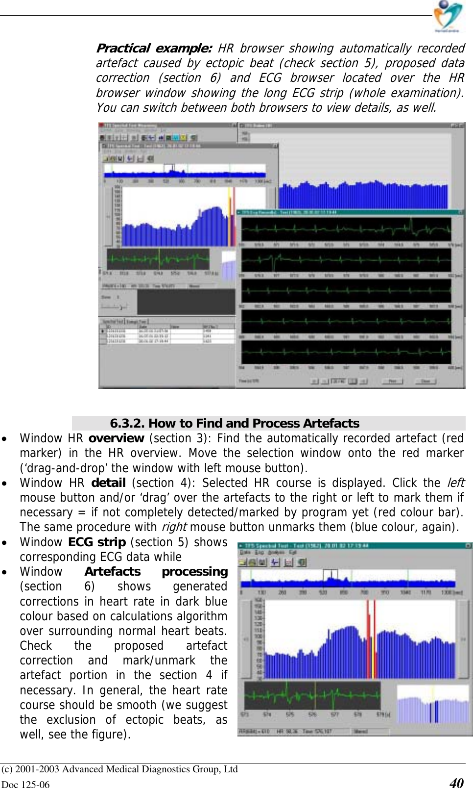    (c) 2001-2003 Advanced Medical Diagnostics Group, Ltd Doc 125-06    40 Practical example: HR browser showing automatically recorded artefact caused by ectopic beat (check section 5), proposed data correction (section 6) and ECG browser located over the HR browser window showing the long ECG strip (whole examination). You can switch between both browsers to view details, as well.     6.3.2. How to Find and Process Artefacts • Window HR overview (section 3): Find the automatically recorded artefact (red marker) in the HR overview. Move the selection window onto the red marker (‘drag-and-drop’ the window with left mouse button).  • Window HR detail (section 4): Selected HR course is displayed. Click the left mouse button and/or ‘drag’ over the artefacts to the right or left to mark them if necessary = if not completely detected/marked by program yet (red colour bar). The same procedure with right mouse button unmarks them (blue colour, again). • Window ECG strip (section 5) shows corresponding ECG data while • Window  Artefacts processing (section 6) shows generated corrections in heart rate in dark blue colour based on calculations algorithm over surrounding normal heart beats. Check the proposed artefact correction and mark/unmark the artefact portion in the section 4 if necessary. In general, the heart rate course should be smooth (we suggest the exclusion of ectopic beats, as well, see the figure). 