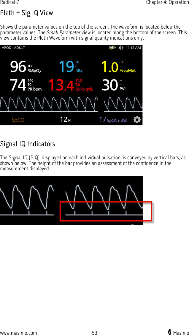 Radical-7   Chapter 4: Operation  www.masimo.com 53   Masimo    Pleth + Sig IQ View Shows the parameter values on the top of the screen. The waveform is located below the parameter values. The Small Parameter view is located along the bottom of the screen. This view contains the Pleth Waveform with signal quality indications only.   Signal IQ Indicators The Signal IQ (SIQ), displayed on each individual pulsation, is conveyed by vertical bars, as shown below. The height of the bar provides an assessment of the confidence in the measurement displayed.   