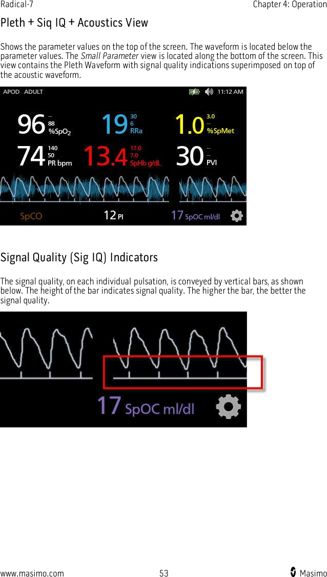 Radical-7    Chapter 4: Operation  www.masimo.com  53    Masimo    Pleth + Siq IQ + Acoustics View Shows the parameter values on the top of the screen. The waveform is located below the parameter values. The Small Parameter view is located along the bottom of the screen. This view contains the Pleth Waveform with signal quality indications superimposed on top of the acoustic waveform.   Signal Quality (Sig IQ) Indicators The signal quality, on each individual pulsation, is conveyed by vertical bars, as shown below. The height of the bar indicates signal quality. The higher the bar, the better the signal quality.   