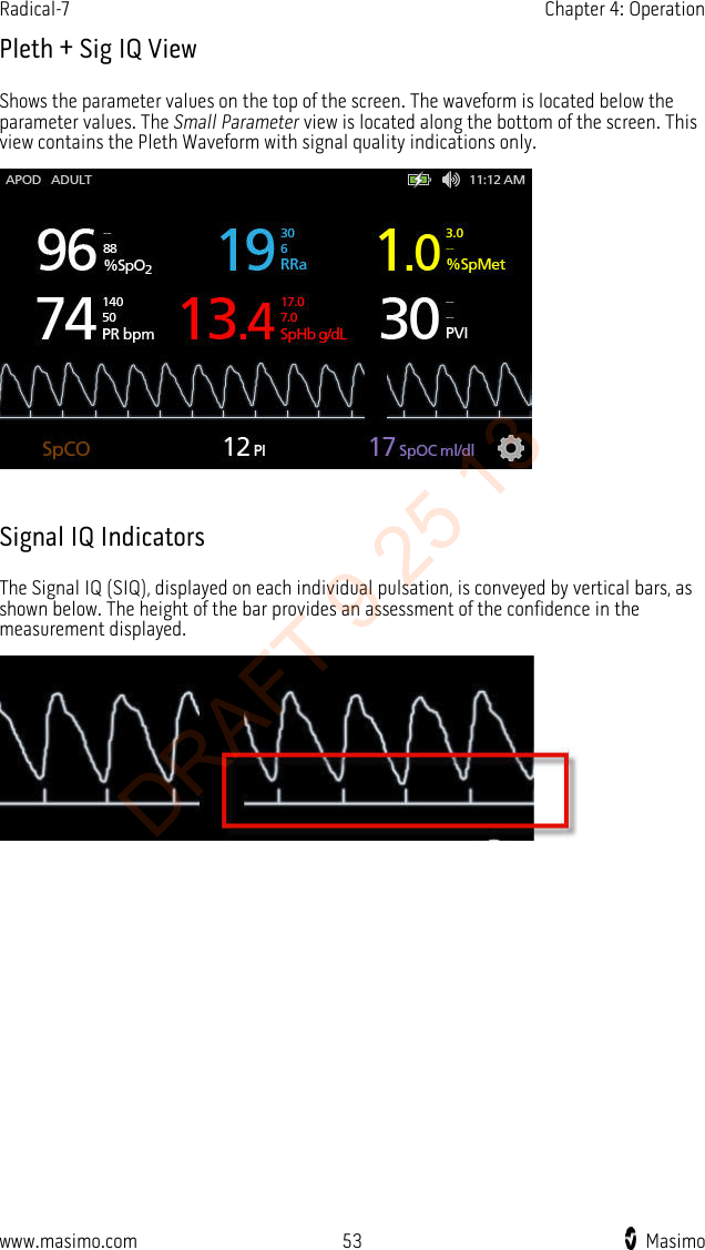 Radical-7    Chapter 4: Operation  Pleth + Sig IQ View Shows the parameter values on the top of the screen. The waveform is located below the parameter values. The Small Parameter view is located along the bottom of the screen. This view contains the Pleth Waveform with signal quality indications only.   Signal IQ Indicators The Signal IQ (SIQ), displayed on each individual pulsation, is conveyed by vertical bars, as shown below. The height of the bar provides an assessment of the confidence in the measurement displayed.   www.masimo.com 53    Masimo    DRAFT 9 25 13