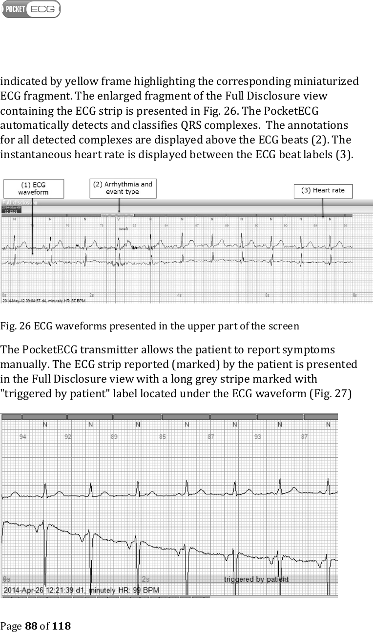    Page 88 of 118  indicated by yellow frame highlighting the corresponding miniaturized ECG fragment. The enlarged fragment of the Full Disclosure view containing the ECG strip is presented in Fig. 26. The PocketECG automatically detects and classifies QRS complexes.  The annotations for all detected complexes are displayed above the ECG beats (2). The instantaneous heart rate is displayed between the ECG beat labels (3). Fig. 26 ECG waveforms presented in the upper part of the screen The PocketECG transmitter allows the patient to report symptoms manually. The ECG strip reported (marked) by the patient is presented in the Full Disclosure view with a long grey stripe marked with &quot;triggered by patient&quot; label located under the ECG waveform (Fig. 27)  