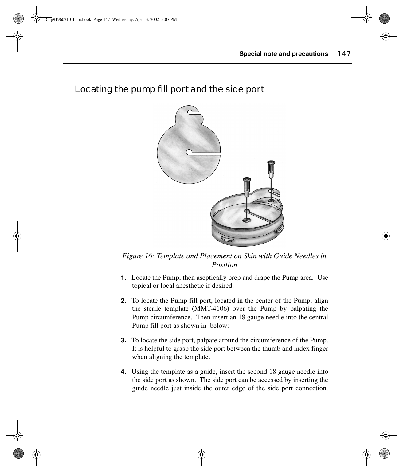 Special note and precautions 147Locating the pump fill port and the side portFigure 16: Template and Placement on Skin with Guide Needles in Position1. Locate the Pump, then aseptically prep and drape the Pump area.  Usetopical or local anesthetic if desired.2. To locate the Pump fill port, located in the center of the Pump, alignthe sterile template (MMT-4106) over the Pump by palpating thePump circumference.  Then insert an 18 gauge needle into the centralPump fill port as shown in  below:3. To locate the side port, palpate around the circumference of the Pump.It is helpful to grasp the side port between the thumb and index fingerwhen aligning the template.4. Using the template as a guide, insert the second 18 gauge needle intothe side port as shown.  The side port can be accessed by inserting theguide needle just inside the outer edge of the side port connection.Dmp9196021-011_c.book  Page 147  Wednesday, April 3, 2002  5:07 PM