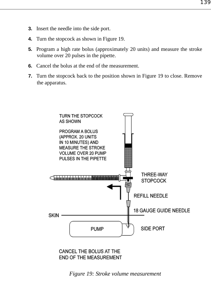 1393. Insert the needle into the side port.4. Turn the stopcock as shown in Figure 19. 5. Program a high rate bolus (approximately 20 units) and measure the strokevolume over 20 pulses in the pipette.6. Cancel the bolus at the end of the measurement.7. Turn the stopcock back to the position shown in Figure 19 to close. Removethe apparatus.Figure 19: Stroke volume measurement