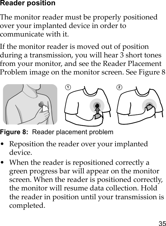 35Reader positionThe monitor reader must be properly positioned over your implanted device in order to communicate with it.If the monitor reader is moved out of position during a transmission, you will hear 3 short tones from your monitor, and see the Reader Placement Problem image on the monitor screen. See Figure 8Figure 8:  Reader placement problem • Reposition the reader over your implanted device. • When the reader is repositioned correctly a green progress bar will appear on the monitor screen. When the reader is positioned correctly, the monitor will resume data collection. Hold the reader in position until your transmission is completed.1 2