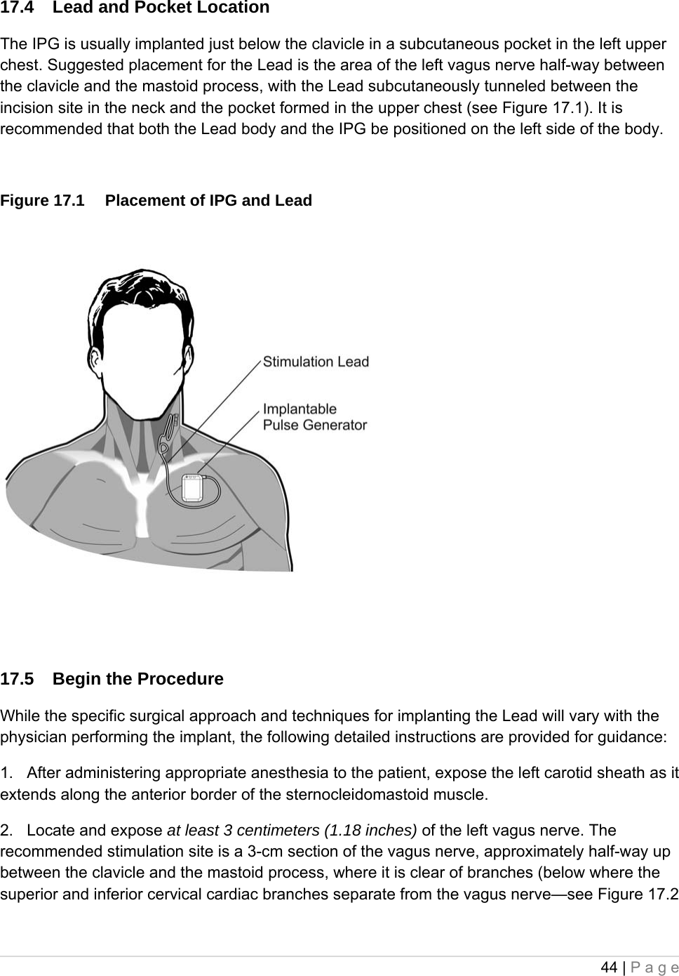 44 | Page  17.4  Lead and Pocket Location  The IPG is usually implanted just below the clavicle in a subcutaneous pocket in the left upper chest. Suggested placement for the Lead is the area of the left vagus nerve half-way between the clavicle and the mastoid process, with the Lead subcutaneously tunneled between the incision site in the neck and the pocket formed in the upper chest (see Figure 17.1). It is recommended that both the Lead body and the IPG be positioned on the left side of the body.   Figure 17.1  Placement of IPG and Lead 17.5  Begin the Procedure While the specific surgical approach and techniques for implanting the Lead will vary with the physician performing the implant, the following detailed instructions are provided for guidance: 1.   After administering appropriate anesthesia to the patient, expose the left carotid sheath as it extends along the anterior border of the sternocleidomastoid muscle.  2.   Locate and expose at least 3 centimeters (1.18 inches) of the left vagus nerve. The recommended stimulation site is a 3-cm section of the vagus nerve, approximately half-way up between the clavicle and the mastoid process, where it is clear of branches (below where the superior and inferior cervical cardiac branches separate from the vagus nerve—see Figure 17.2 