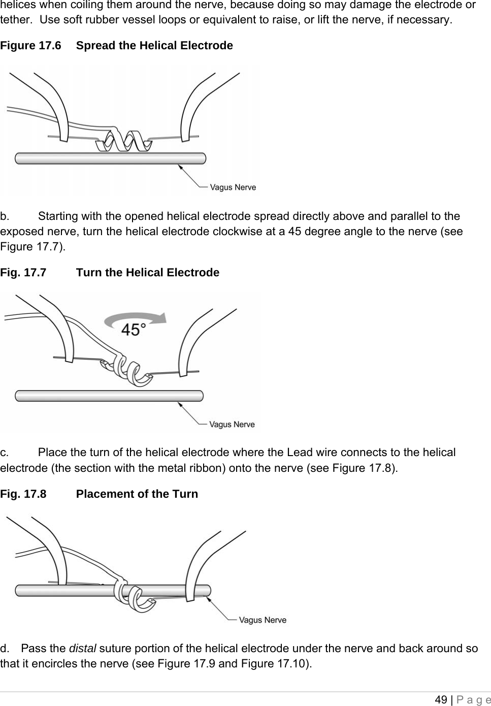 49 | Page  helices when coiling them around the nerve, because doing so may damage the electrode or tether.  Use soft rubber vessel loops or equivalent to raise, or lift the nerve, if necessary. Figure 17.6  Spread the Helical Electrode  b.  Starting with the opened helical electrode spread directly above and parallel to the exposed nerve, turn the helical electrode clockwise at a 45 degree angle to the nerve (see Figure 17.7). Fig. 17.7  Turn the Helical Electrode  c.  Place the turn of the helical electrode where the Lead wire connects to the helical electrode (the section with the metal ribbon) onto the nerve (see Figure 17.8). Fig. 17.8  Placement of the Turn  d.    Pass the distal suture portion of the helical electrode under the nerve and back around so that it encircles the nerve (see Figure 17.9 and Figure 17.10). 