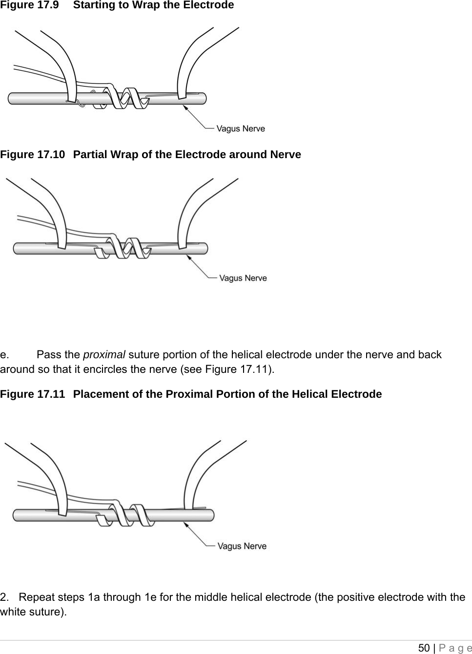 50 | Page   Figure 17.9  Starting to Wrap the Electrode  Figure 17.10  Partial Wrap of the Electrode around Nerve                                 e. Pass the proximal suture portion of the helical electrode under the nerve and back around so that it encircles the nerve (see Figure 17.11). Figure 17.11  Placement of the Proximal Portion of the Helical Electrode    2.   Repeat steps 1a through 1e for the middle helical electrode (the positive electrode with the white suture). 