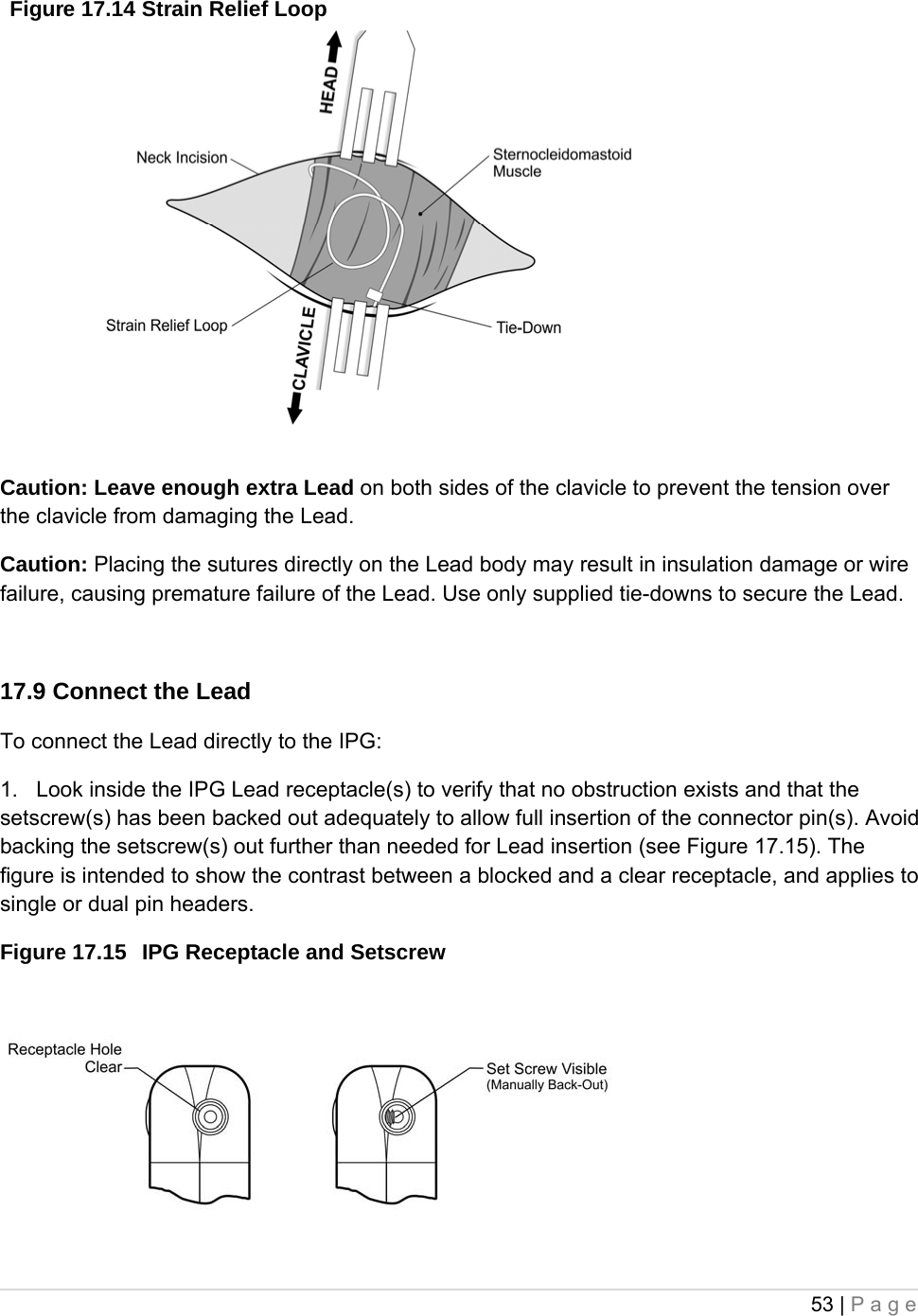 53 | Page  Figure 17.14 Strain Relief Loop   Caution: Leave enough extra Lead on both sides of the clavicle to prevent the tension over the clavicle from damaging the Lead. Caution: Placing the sutures directly on the Lead body may result in insulation damage or wire failure, causing premature failure of the Lead. Use only supplied tie-downs to secure the Lead.  17.9 Connect the Lead To connect the Lead directly to the IPG: 1.   Look inside the IPG Lead receptacle(s) to verify that no obstruction exists and that the setscrew(s) has been backed out adequately to allow full insertion of the connector pin(s). Avoid backing the setscrew(s) out further than needed for Lead insertion (see Figure 17.15). The figure is intended to show the contrast between a blocked and a clear receptacle, and applies to single or dual pin headers. Figure 17.15  IPG Receptacle and Setscrew    