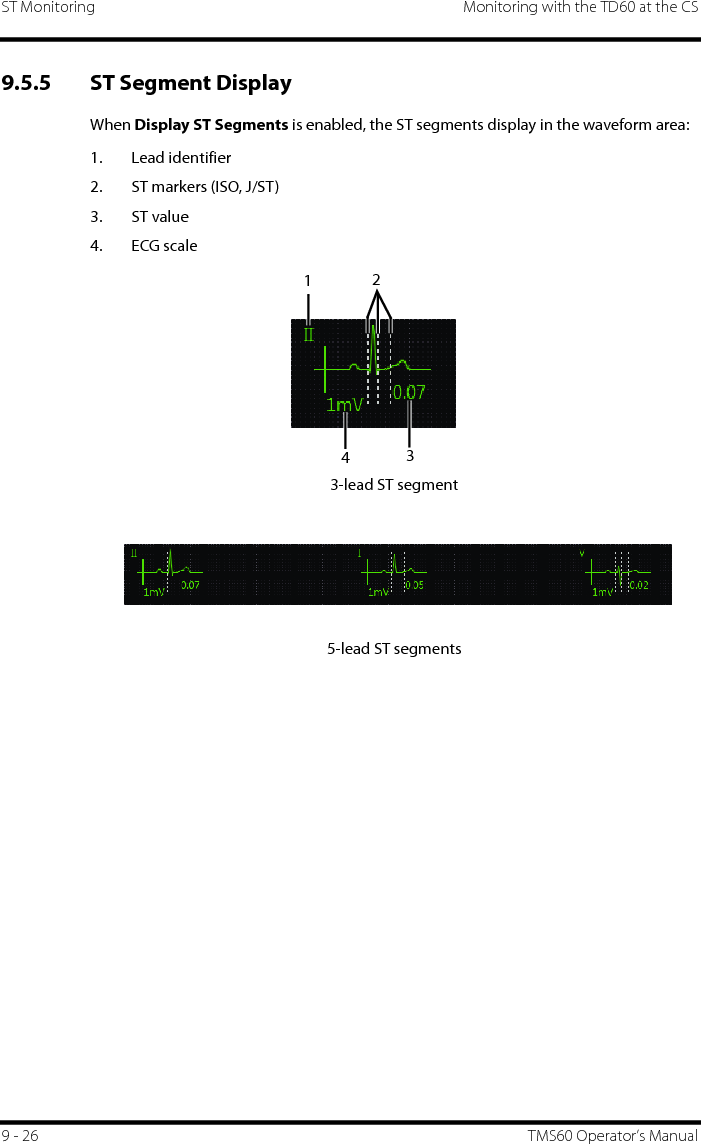 ST Monitoring Monitoring with the TD60 at the CS9 - 26 TMS60 Operator’s Manual9.5.5 ST Segment DisplayWhen Display ST Segments is enabled, the ST segments display in the waveform area:1. Lead identifier2. ST markers (ISO, J/ST)3. ST value4. ECG scale3-lead ST segment5-lead ST segments1234