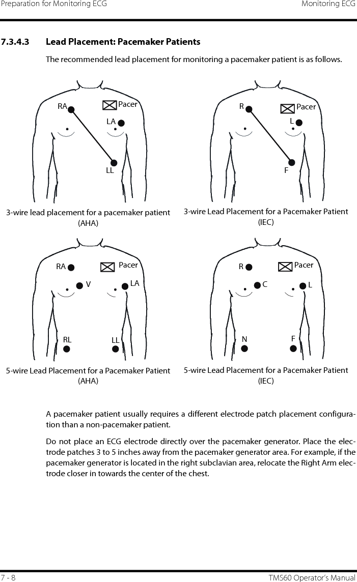 Preparation for Monitoring ECG Monitoring ECG7 - 8 TMS60 Operator’s Manual7.3.4.3 Lead Placement: Pacemaker PatientsThe recommended lead placement for monitoring a pacemaker patient is as follows.A pacemaker patient usually requires a different electrode patch placement configura-tion than a non-pacemaker patient.Do not place an ECG electrode directly over the pacemaker generator. Place the elec-trode patches 3 to 5 inches away from the pacemaker generator area. For example, if thepacemaker generator is located in the right subclavian area, relocate the Right Arm elec-trode closer in towards the center of the chest.3-wire lead placement for a pacemaker patient (AHA)3-wire Lead Placement for a Pacemaker Patient (IEC)5-wire Lead Placement for a Pacemaker Patient (AHA)5-wire Lead Placement for a Pacemaker Patient (IEC)RALALLPacerRLFPacerPacerRAVLALLRLPacerRLCNF