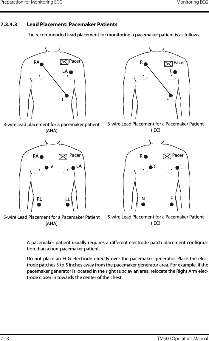 Preparation for Monitoring ECG Monitoring ECG7 - 8 TMS60 Operator’s Manual7.3.4.3 Lead Placement: Pacemaker PatientsThe recommended lead placement for monitoring a pacemaker patient is as follows.A pacemaker patient usually requires a different electrode patch placement configura-tion than a non-pacemaker patient.Do not place an ECG electrode directly over the pacemaker generator. Place the elec-trode patches 3 to 5 inches away from the pacemaker generator area. For example, if thepacemaker generator is located in the right subclavian area, relocate the Right Arm elec-trode closer in towards the center of the chest.3-wire lead placement for a pacemaker patient (AHA)3-wire Lead Placement for a Pacemaker Patient (IEC)5-wire Lead Placement for a Pacemaker Patient (AHA)5-wire Lead Placement for a Pacemaker Patient (IEC)RALALLPacerRLFPacerPacerRAVLALLRLPacerRLCNF